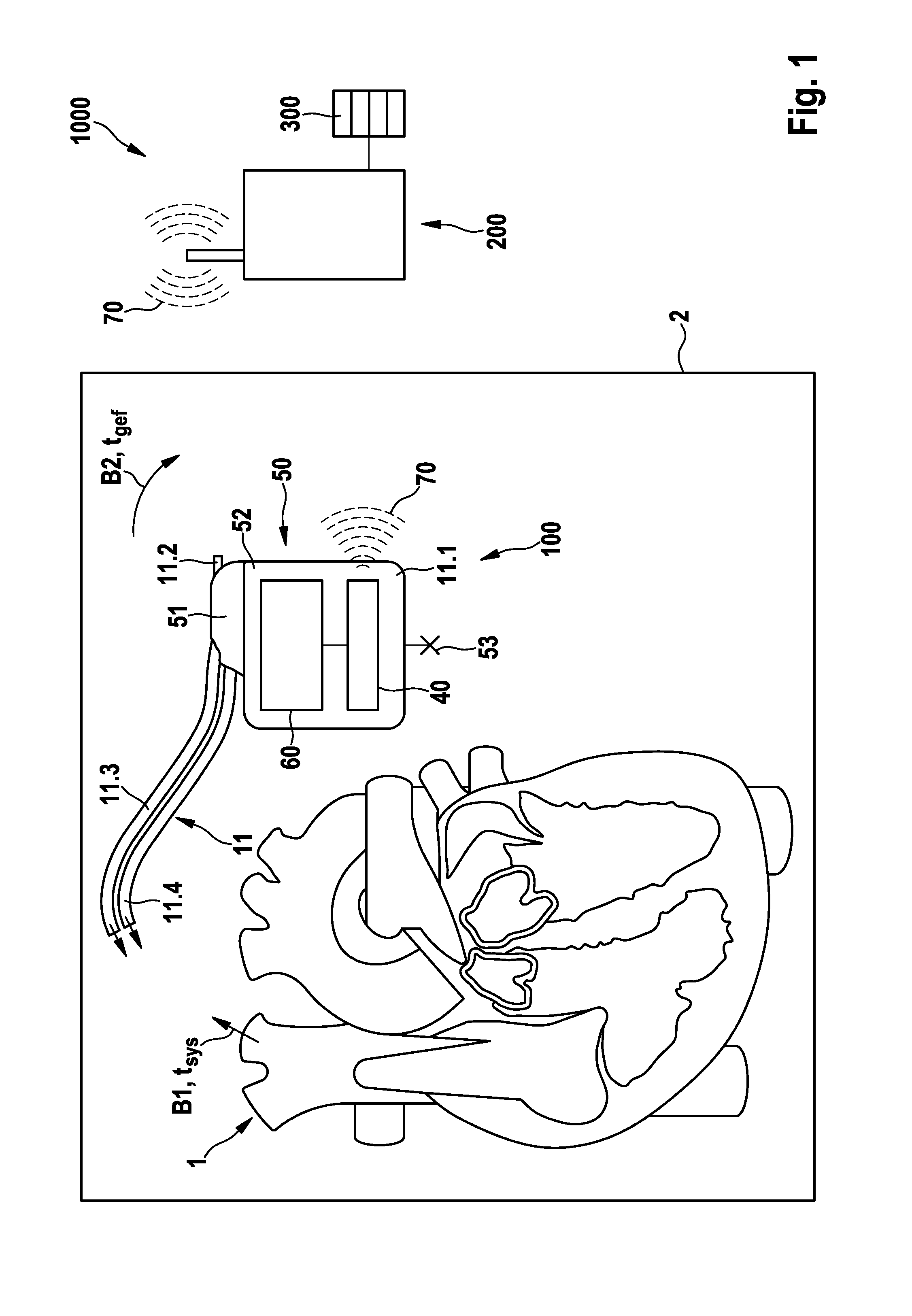 Electromedical implant and monitoring system including the electromedical implant