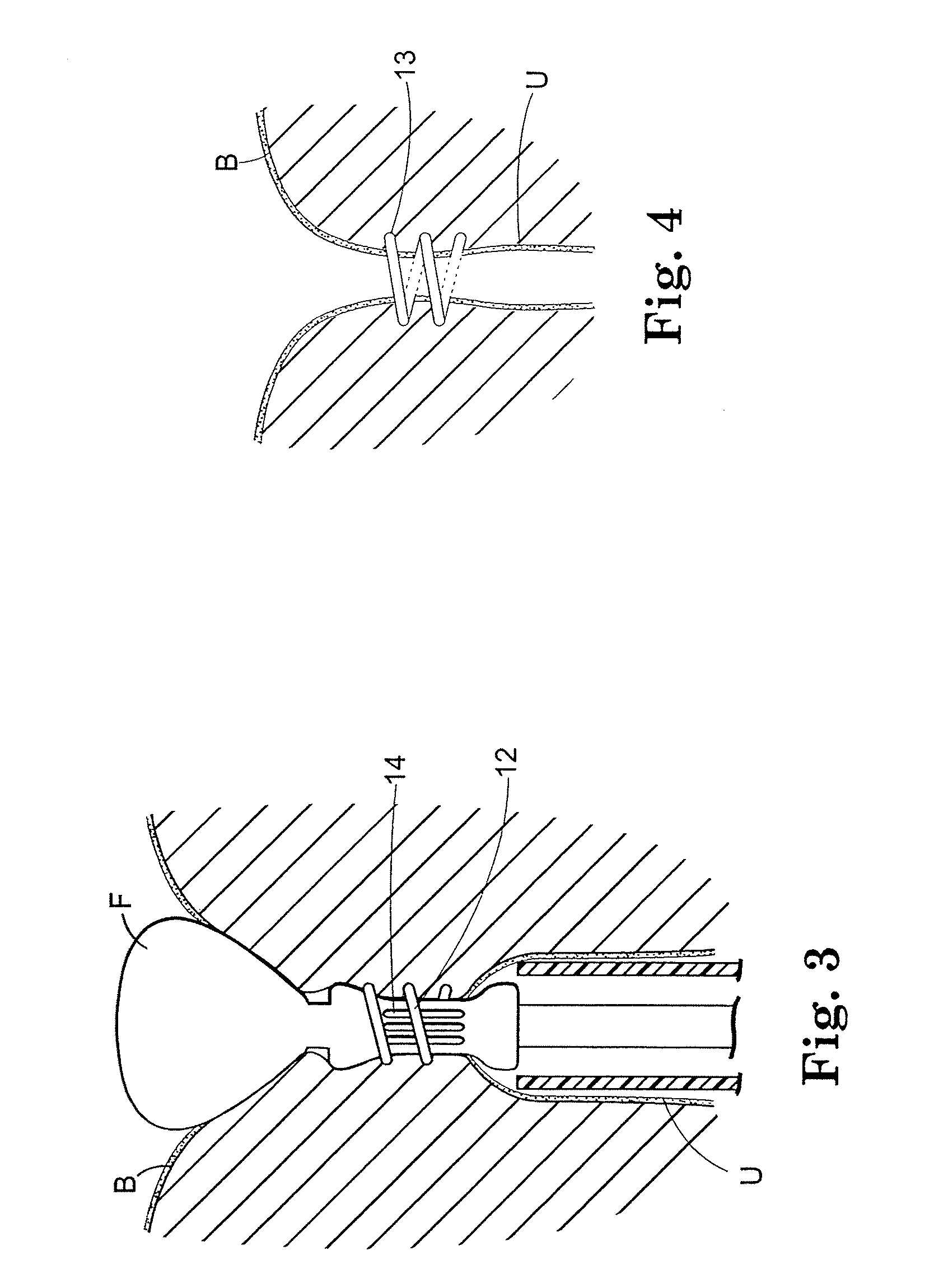 Surgical Articles for Placing an Implant about a Tubular Tissue Structure and Methods