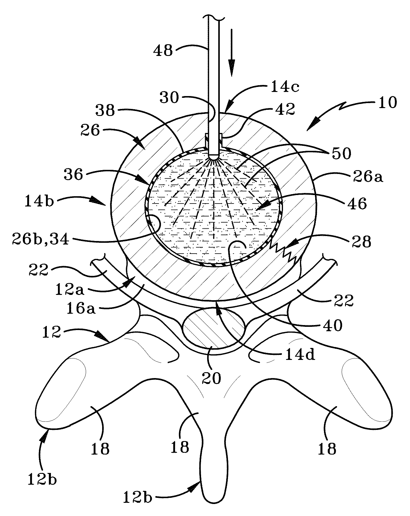 Nucleus pulposus spinal implant and method of using the same