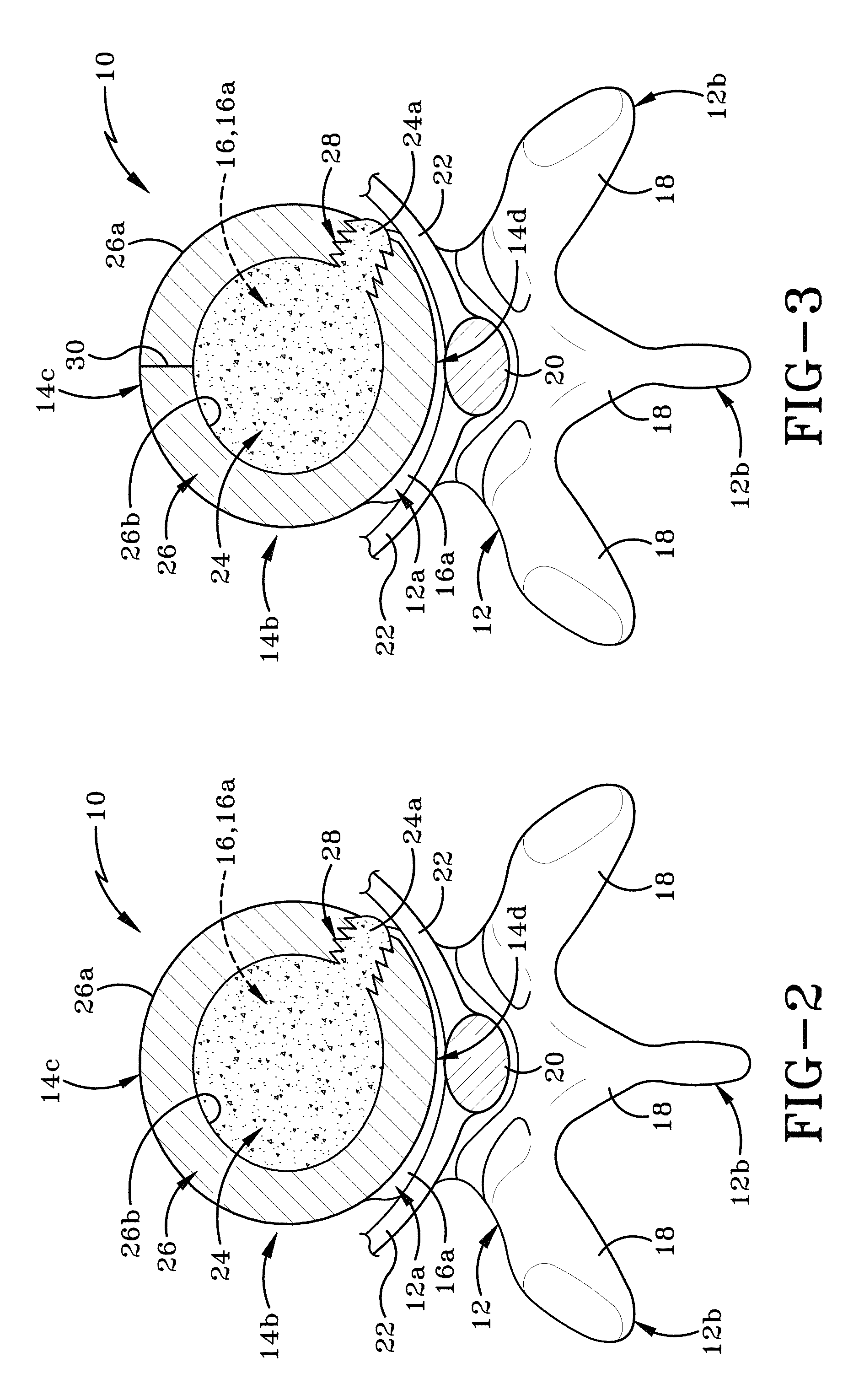 Nucleus pulposus spinal implant and method of using the same