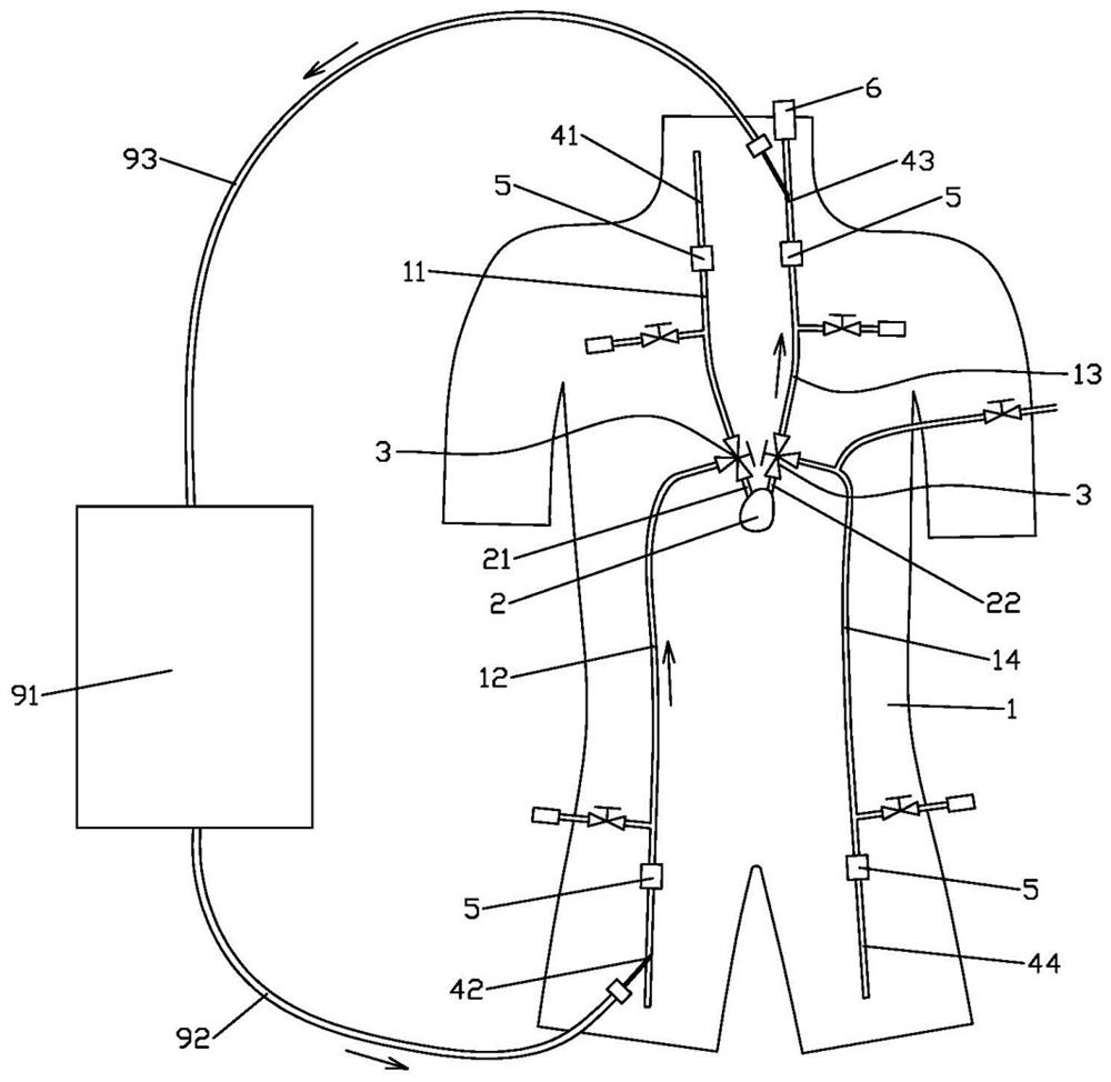 An ecmo simulation training human body model for easy exhaust