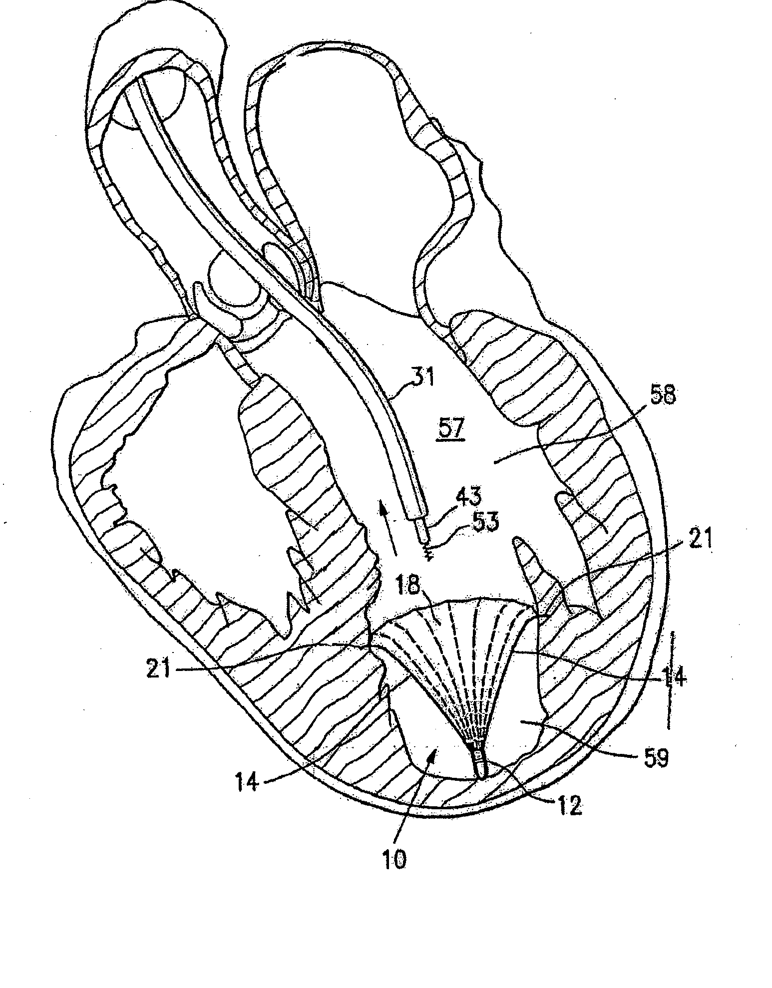 Laminar ventricular partitioning device
