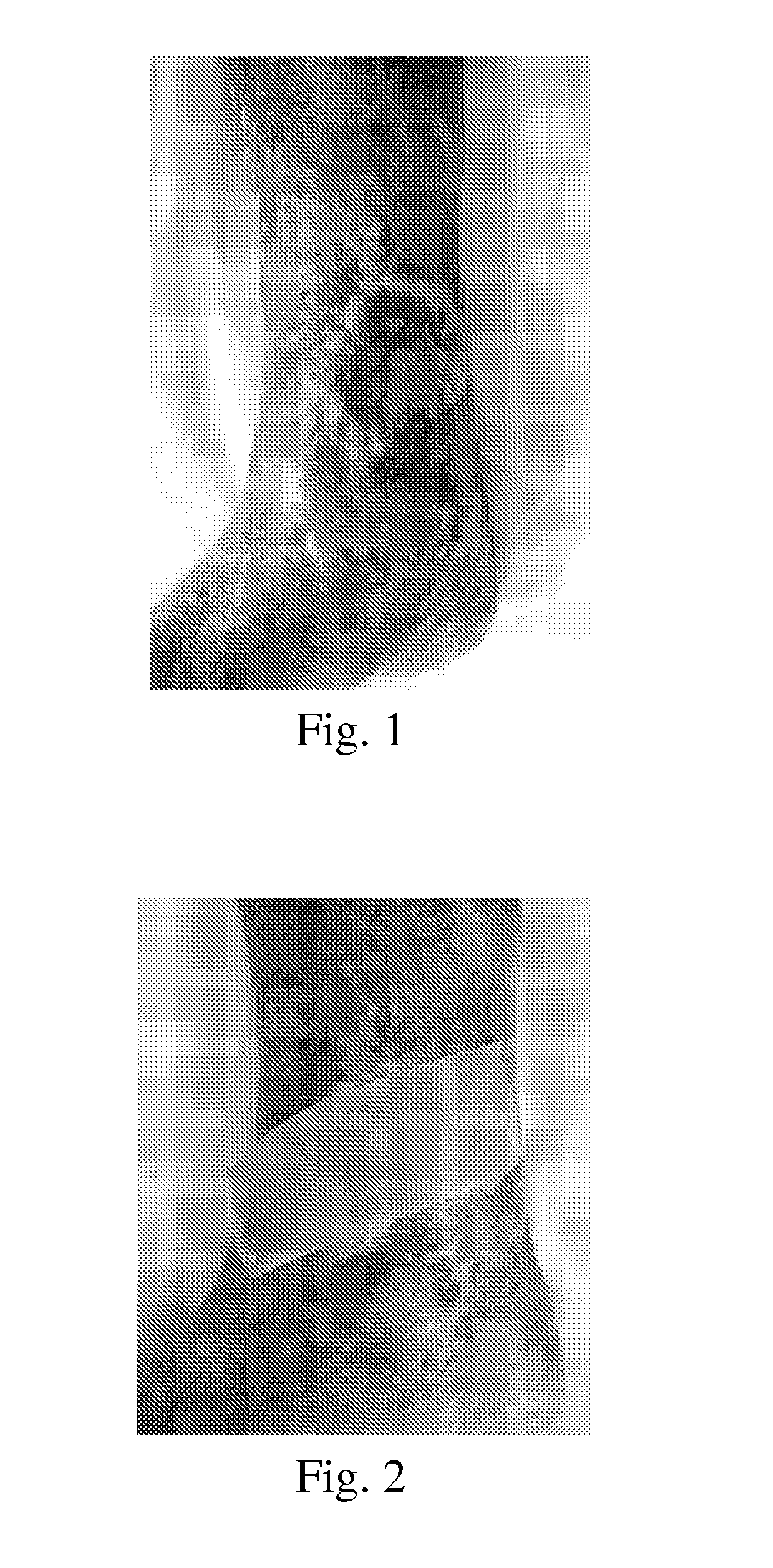 Use of pharmaceutical compositions in preparing pharmaceuticals for treating diabetic ulcer
