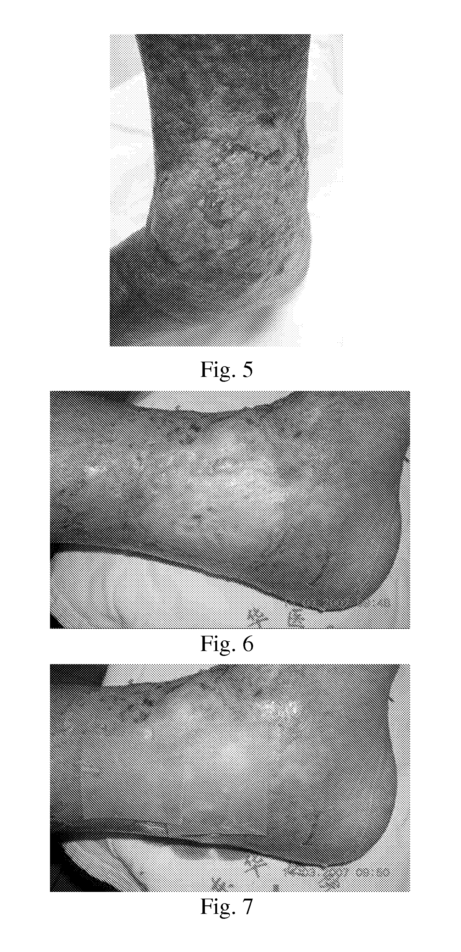 Use of pharmaceutical compositions in preparing pharmaceuticals for treating diabetic ulcer