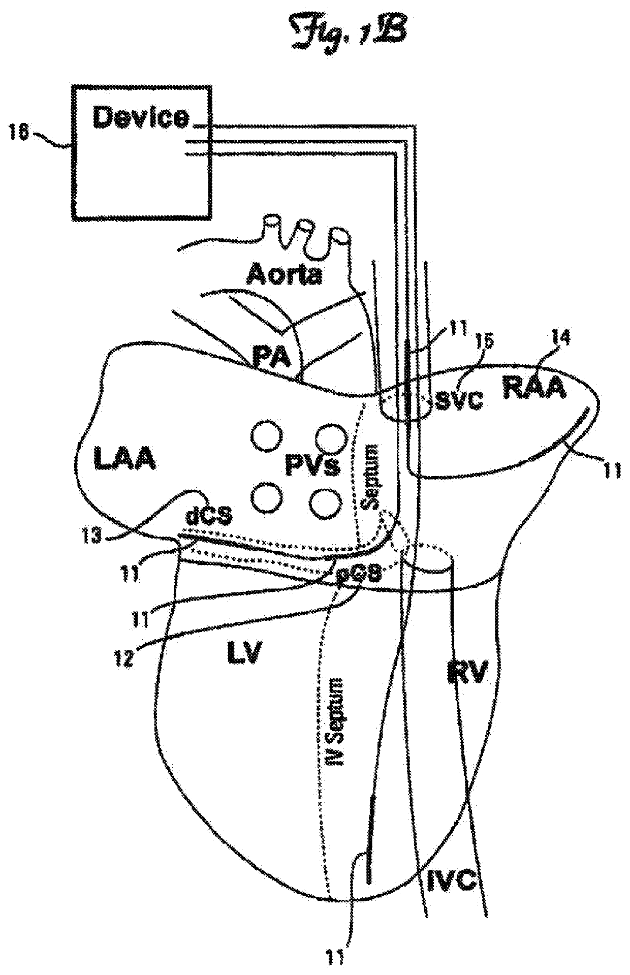 Method and device for atrial cardioversion therapy