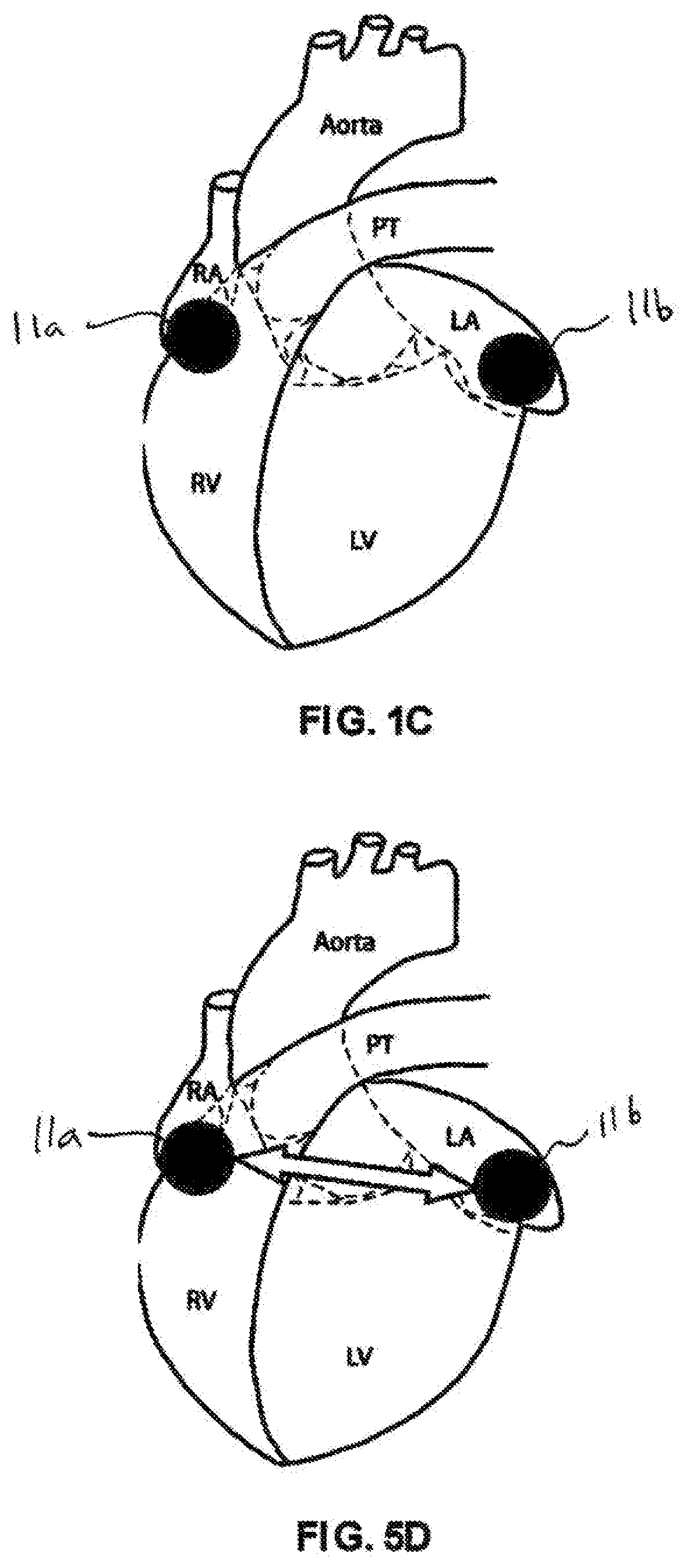 Method and device for atrial cardioversion therapy