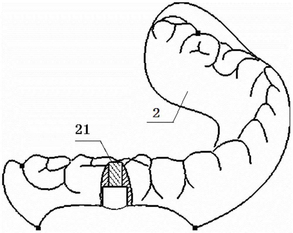 Whole-tooth lost dental implantation operation guide plate and making method thereof