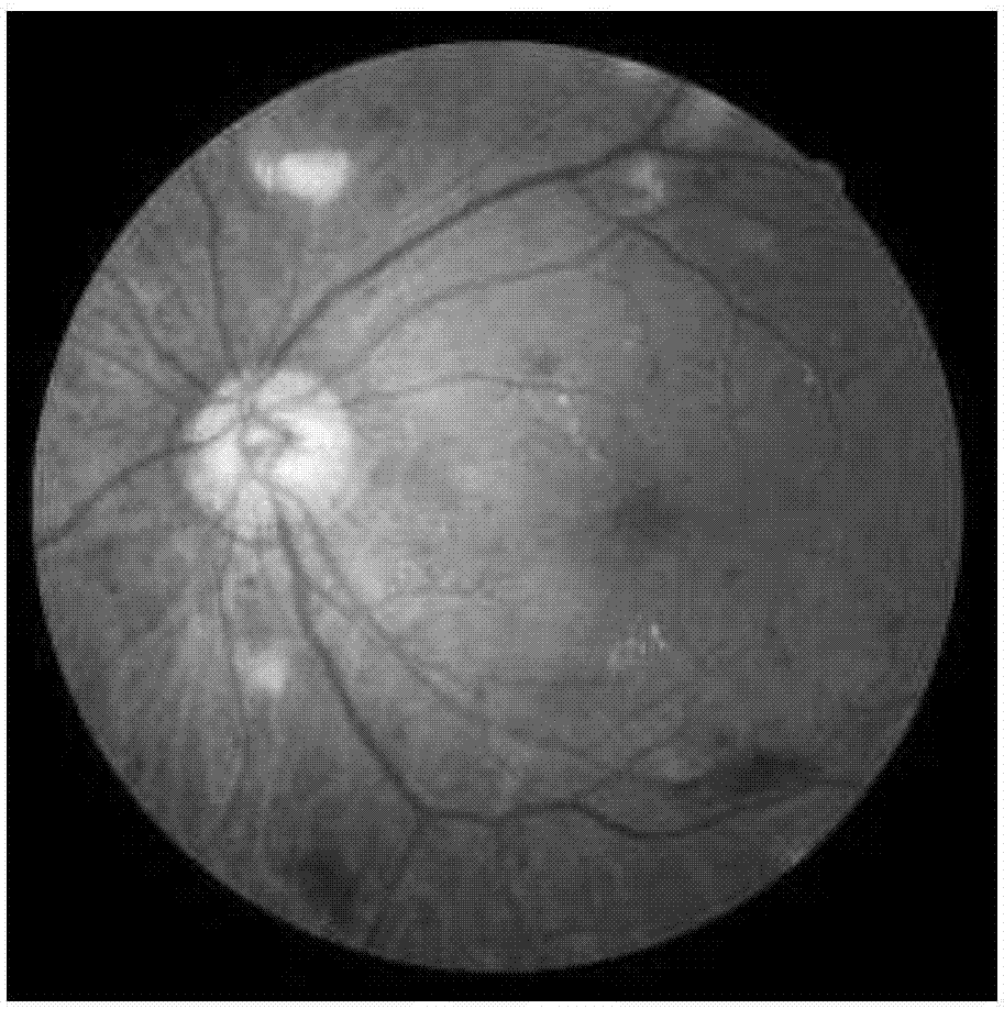 Diabetic retinopathy fundus photography standard image generation method
