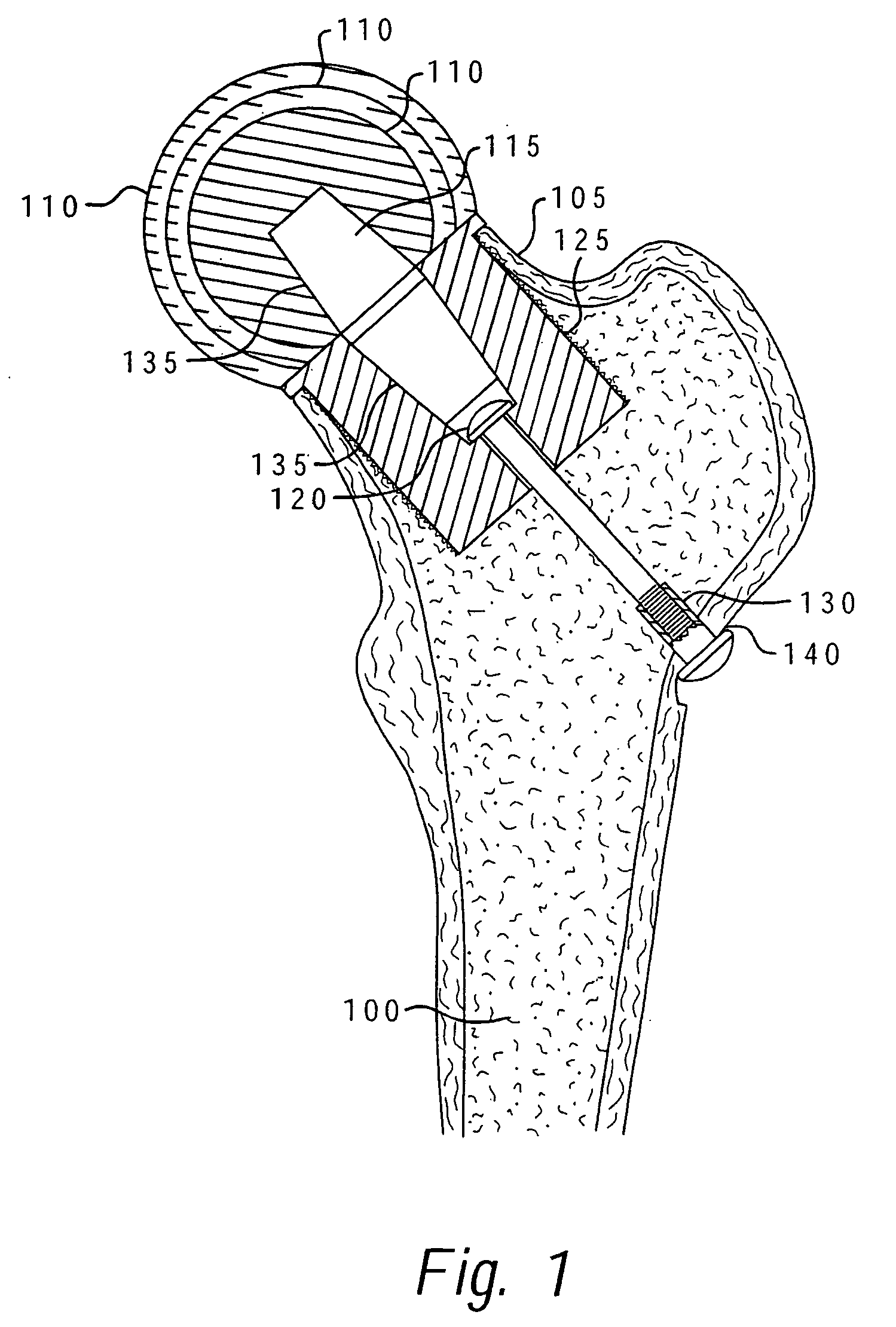 Method of resecting a femoral head for implantation of a femoral neck fixation prosthesis