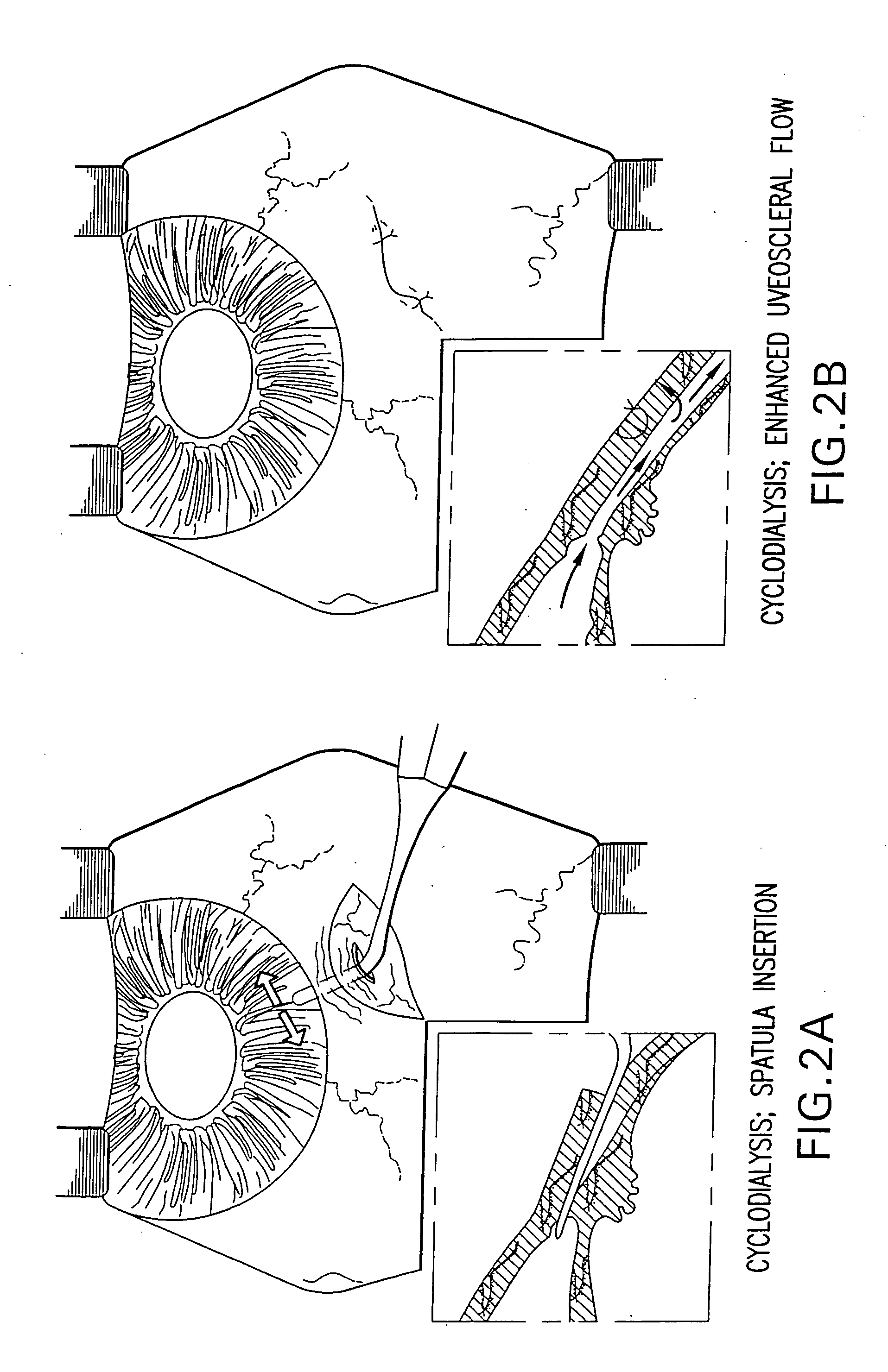 Uveoscleral drainage device
