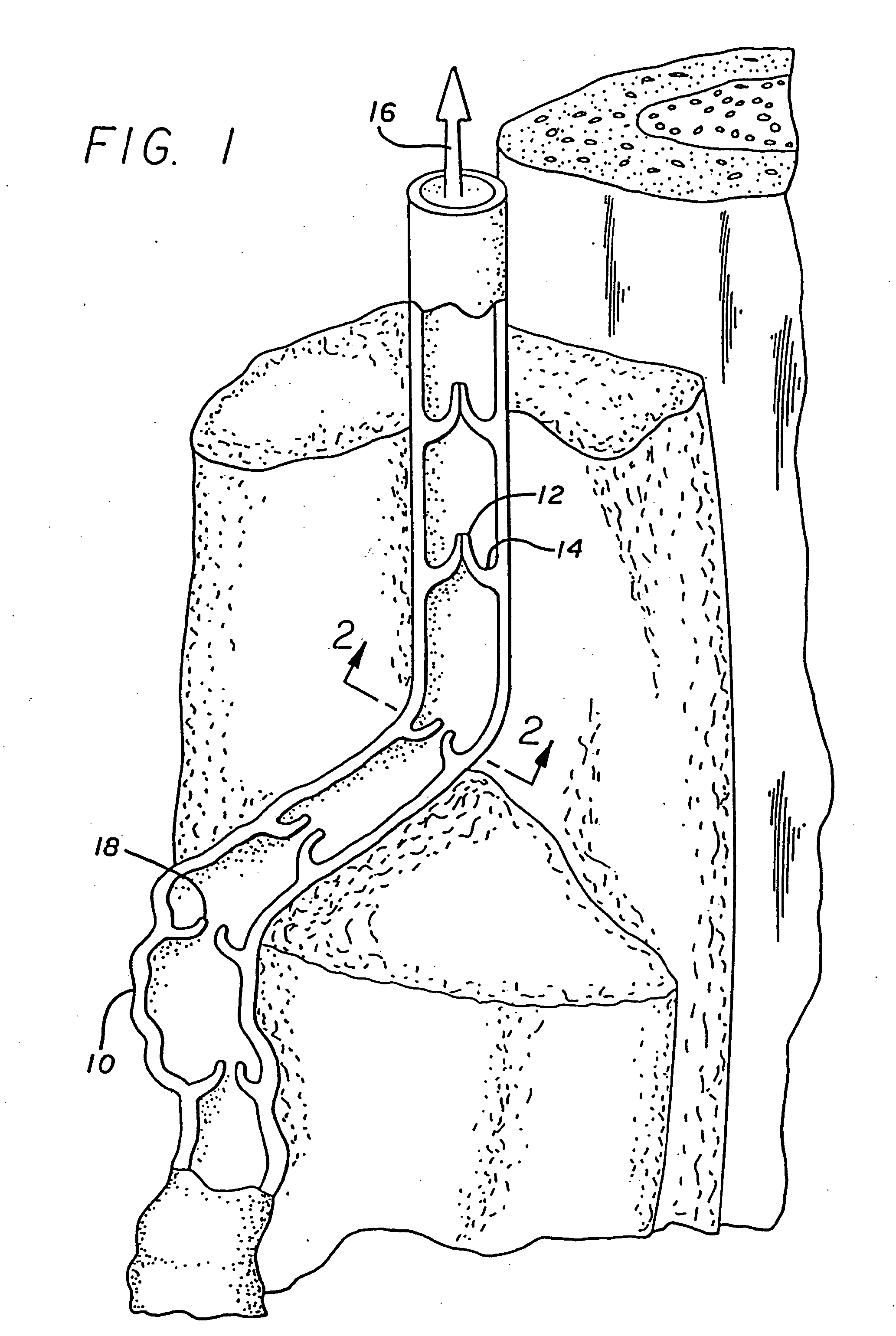 Apparatus for Treating Venous Insufficiency Using Directionally Applied Energy