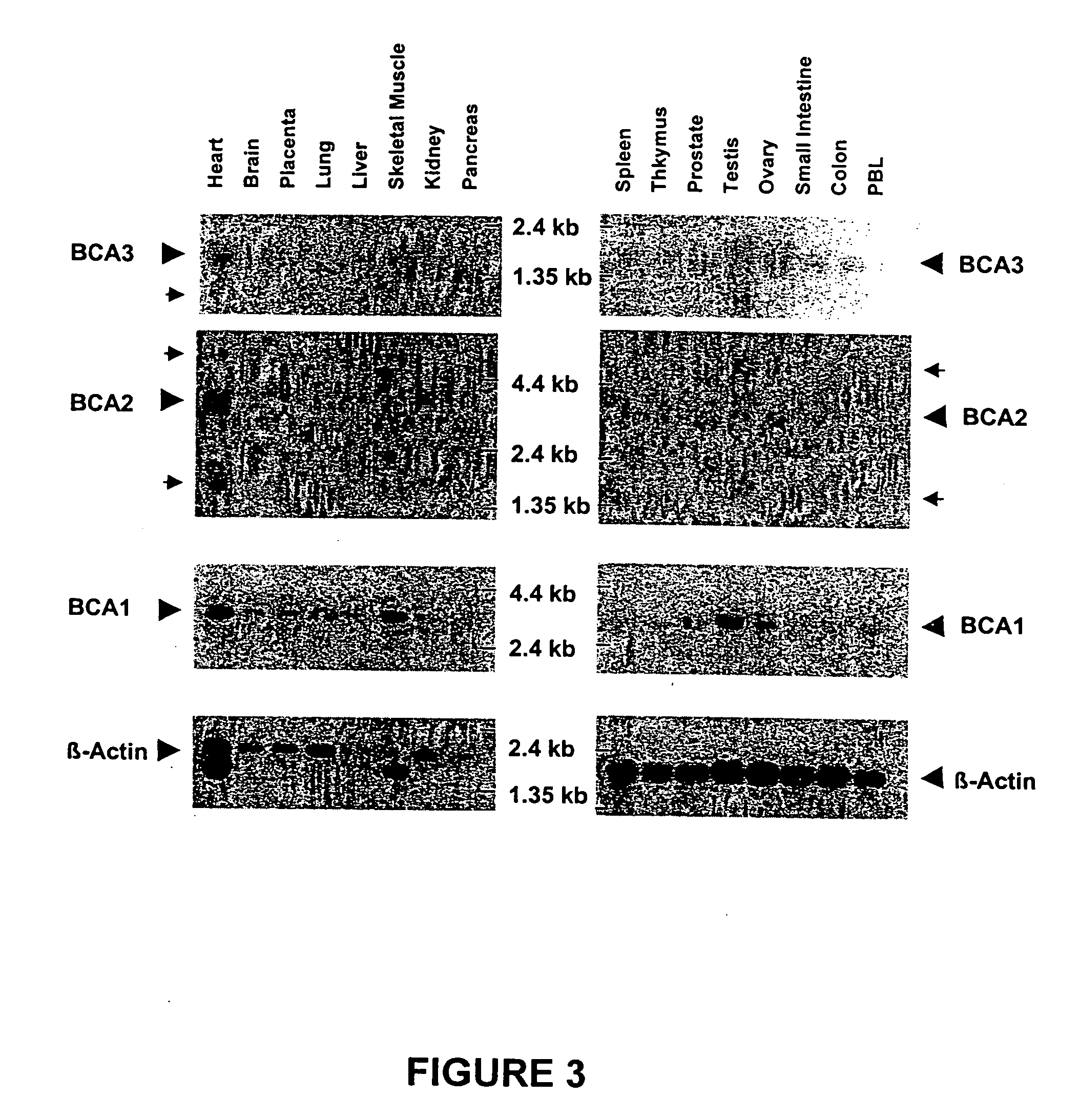 Breast cancer-associated genes and uses thereof