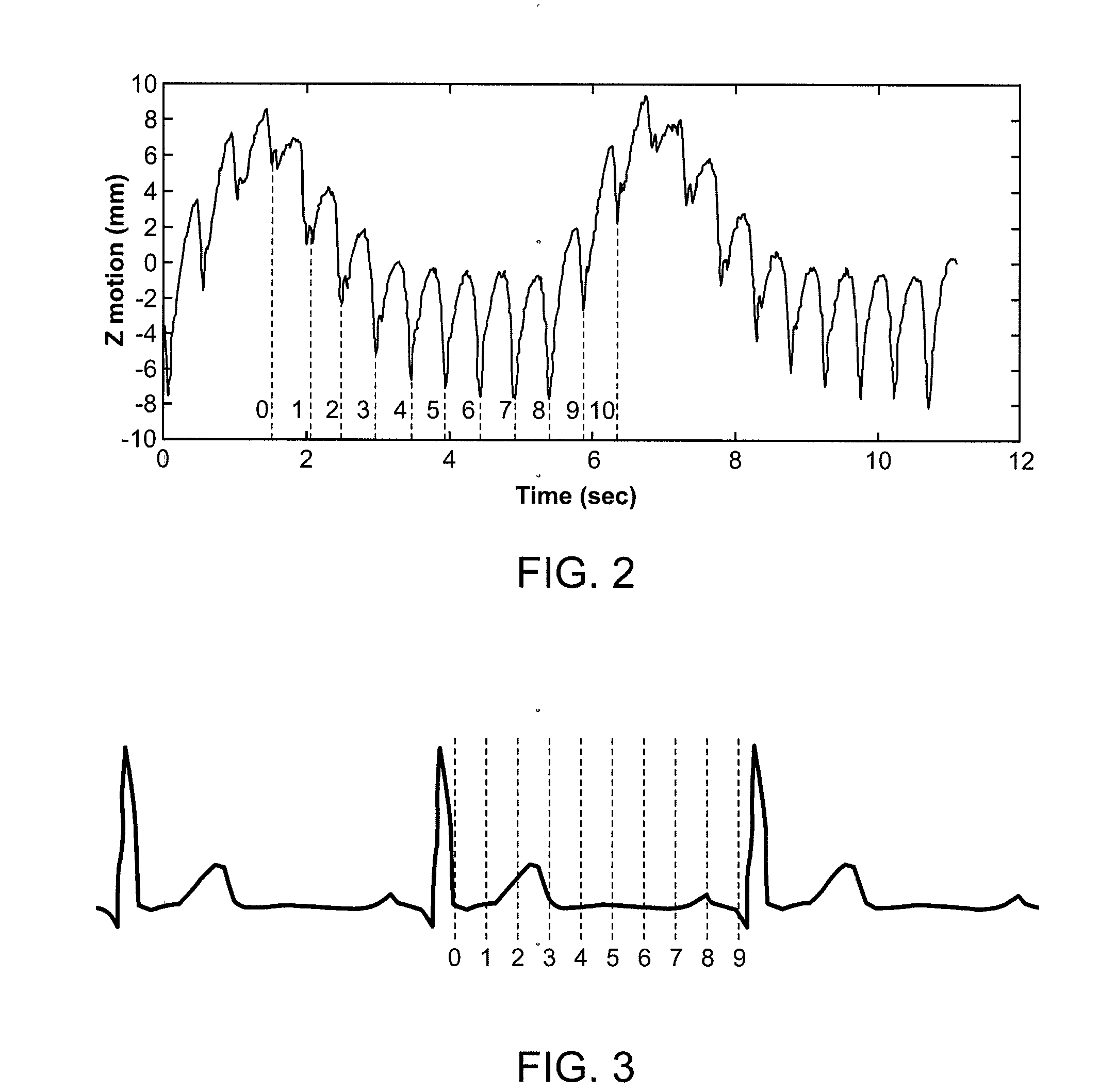 Method for Depositing Radiation in Heart Muscle