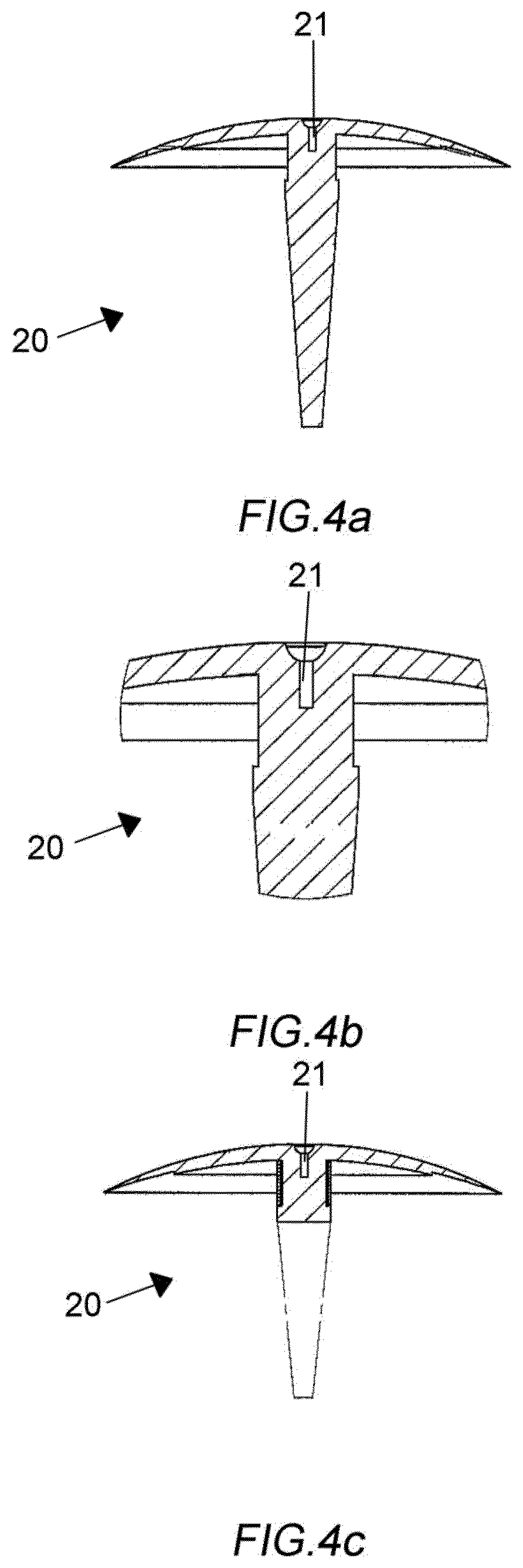 Expander of orthotopic artificial bladder endoprosthesis