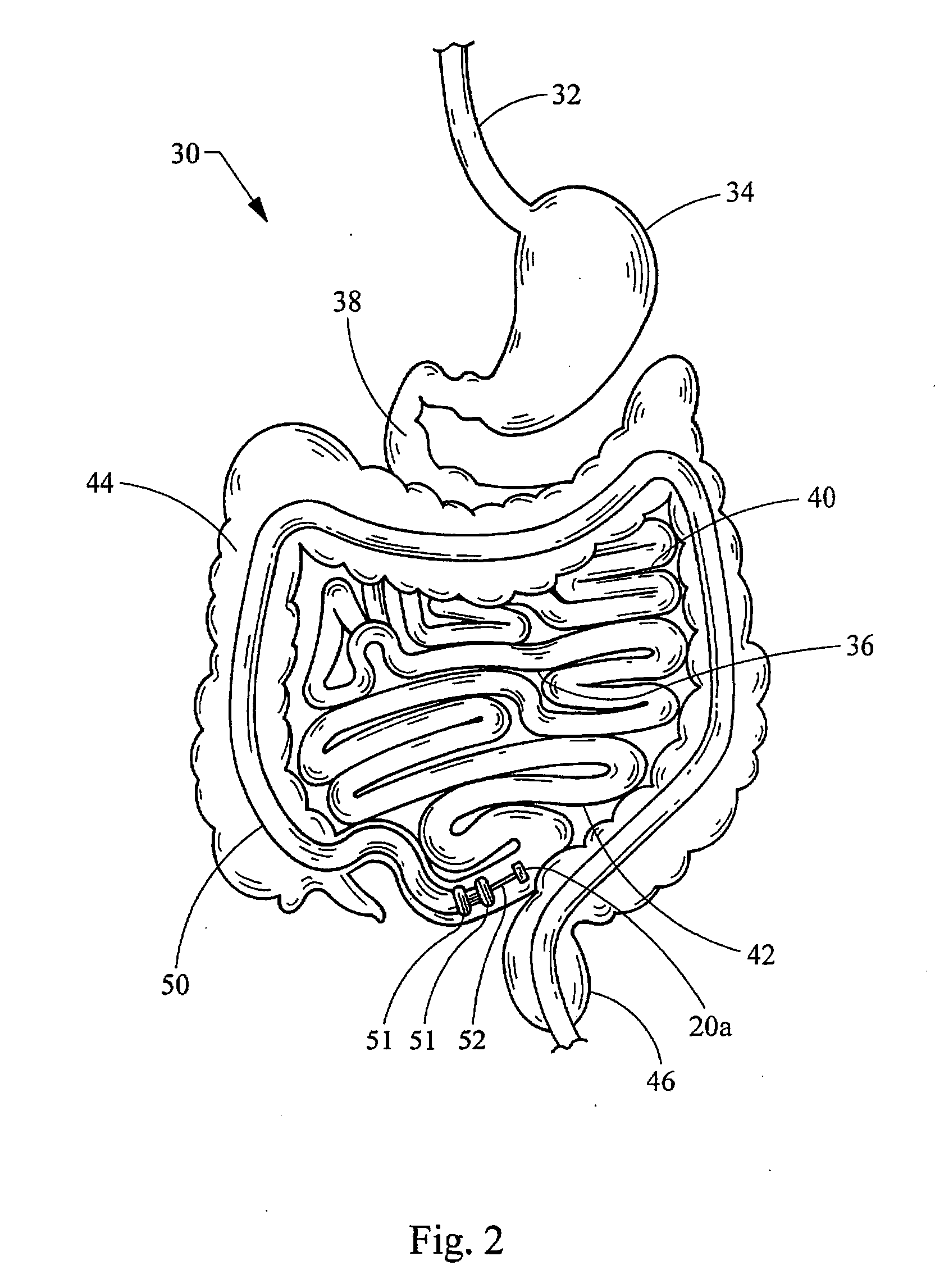 Intestinal bypass using magnets