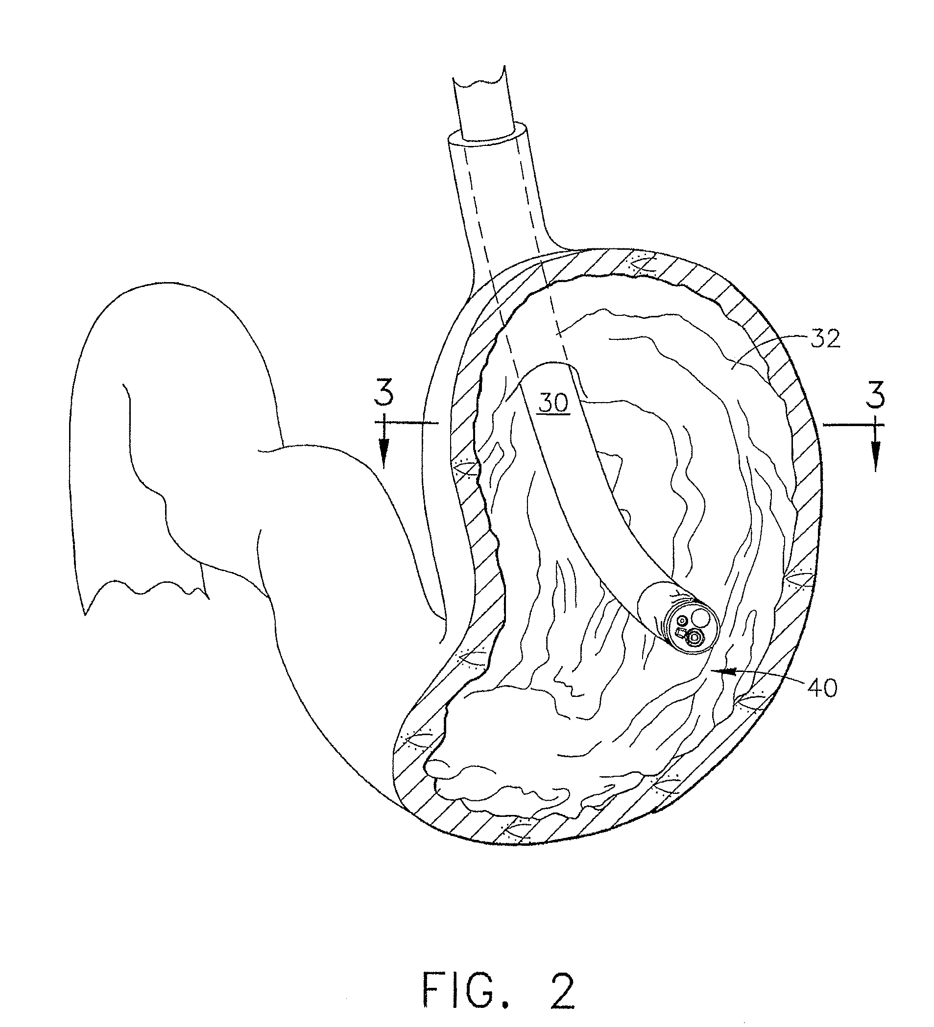 Device for insufflating the interior of a gastric cavity of a patient