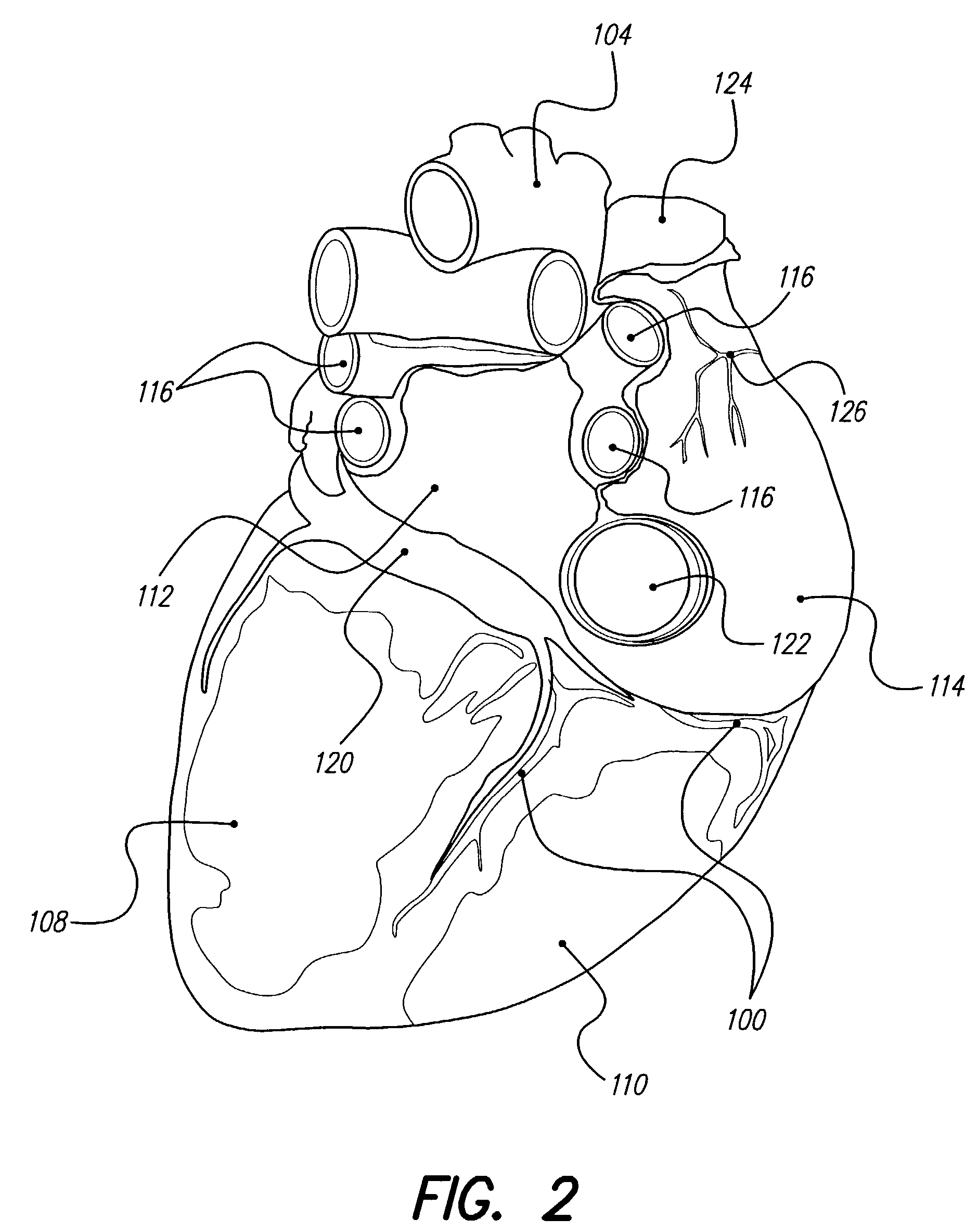 Systems and methods for treatment of coronary artery disease