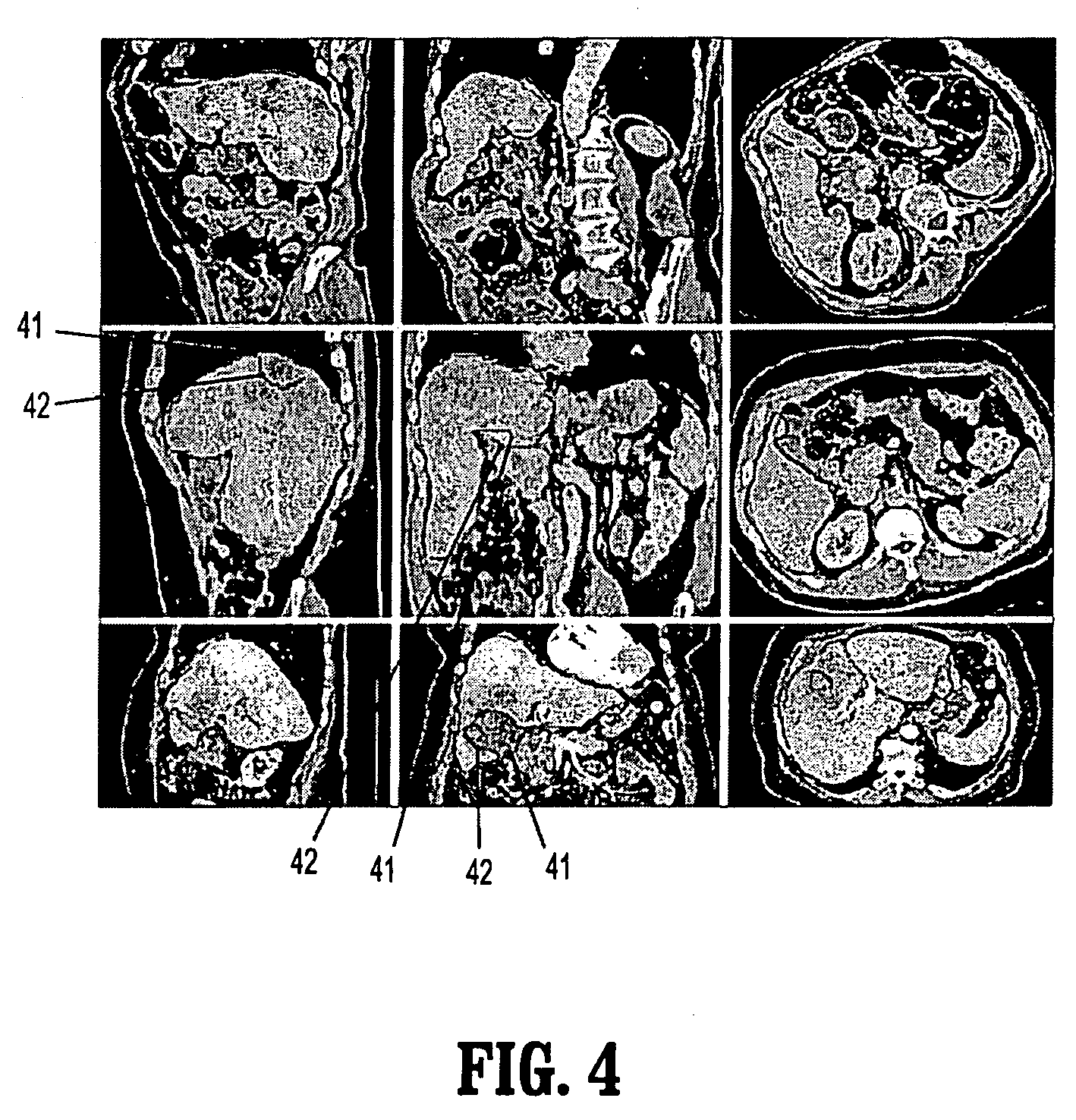 System and method for global-to-local shape matching for automatic liver segmentation in medical imaging