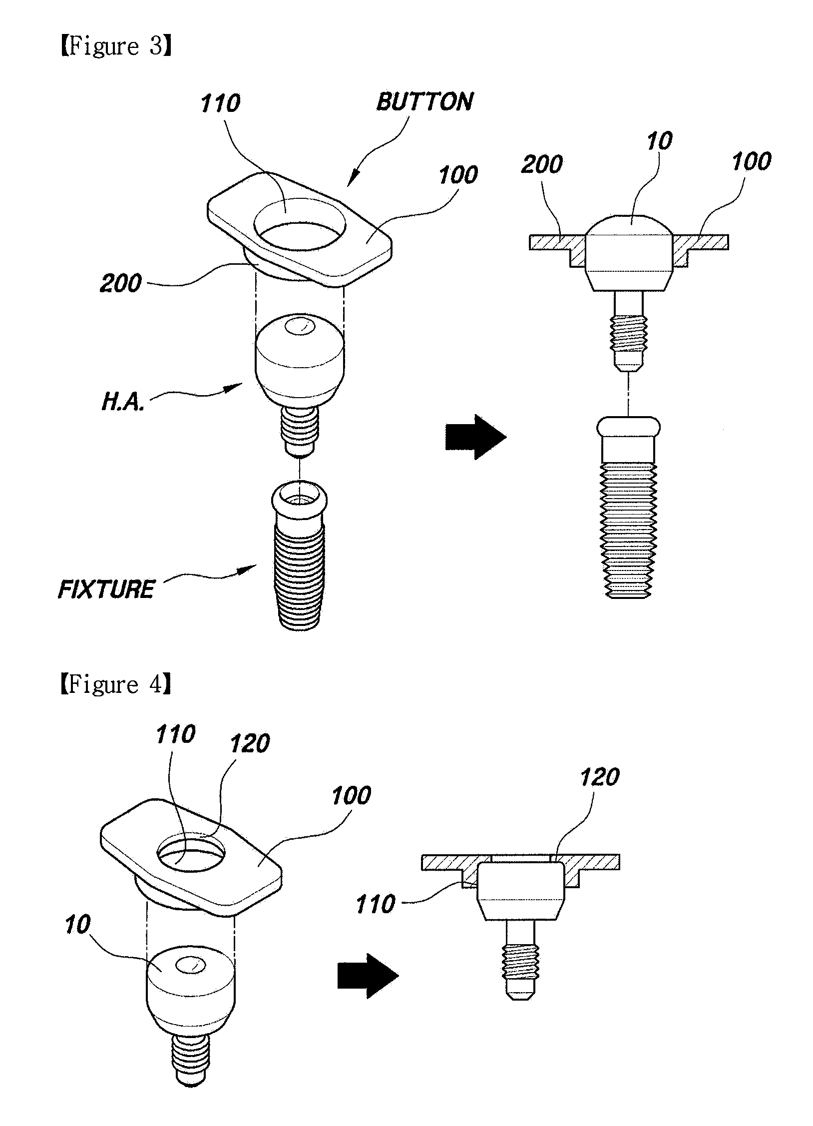Button for implant healing abutment and implant healing abutment having pressing part