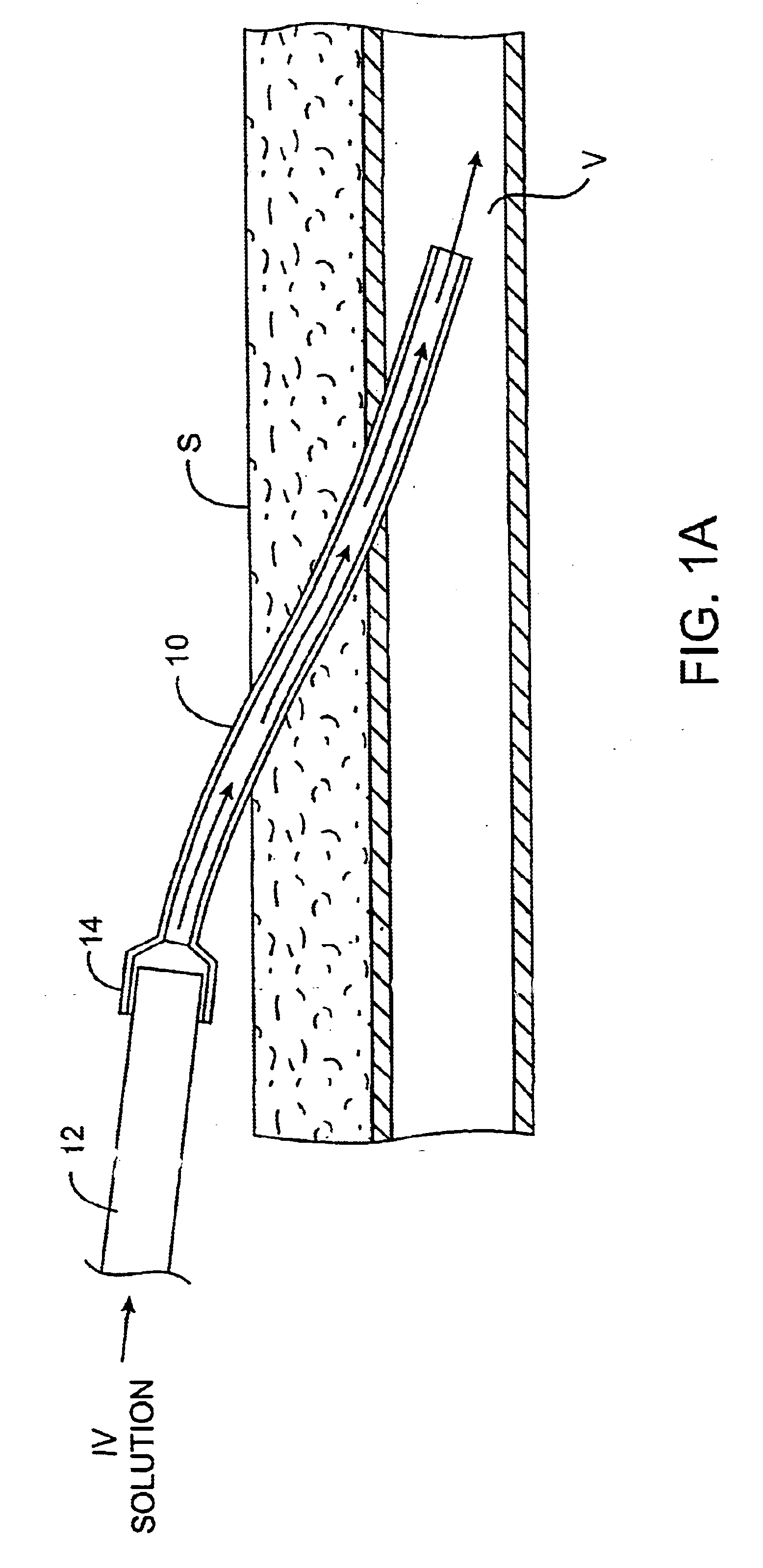 Methods and kits for locking and disinfecting implanted catheters