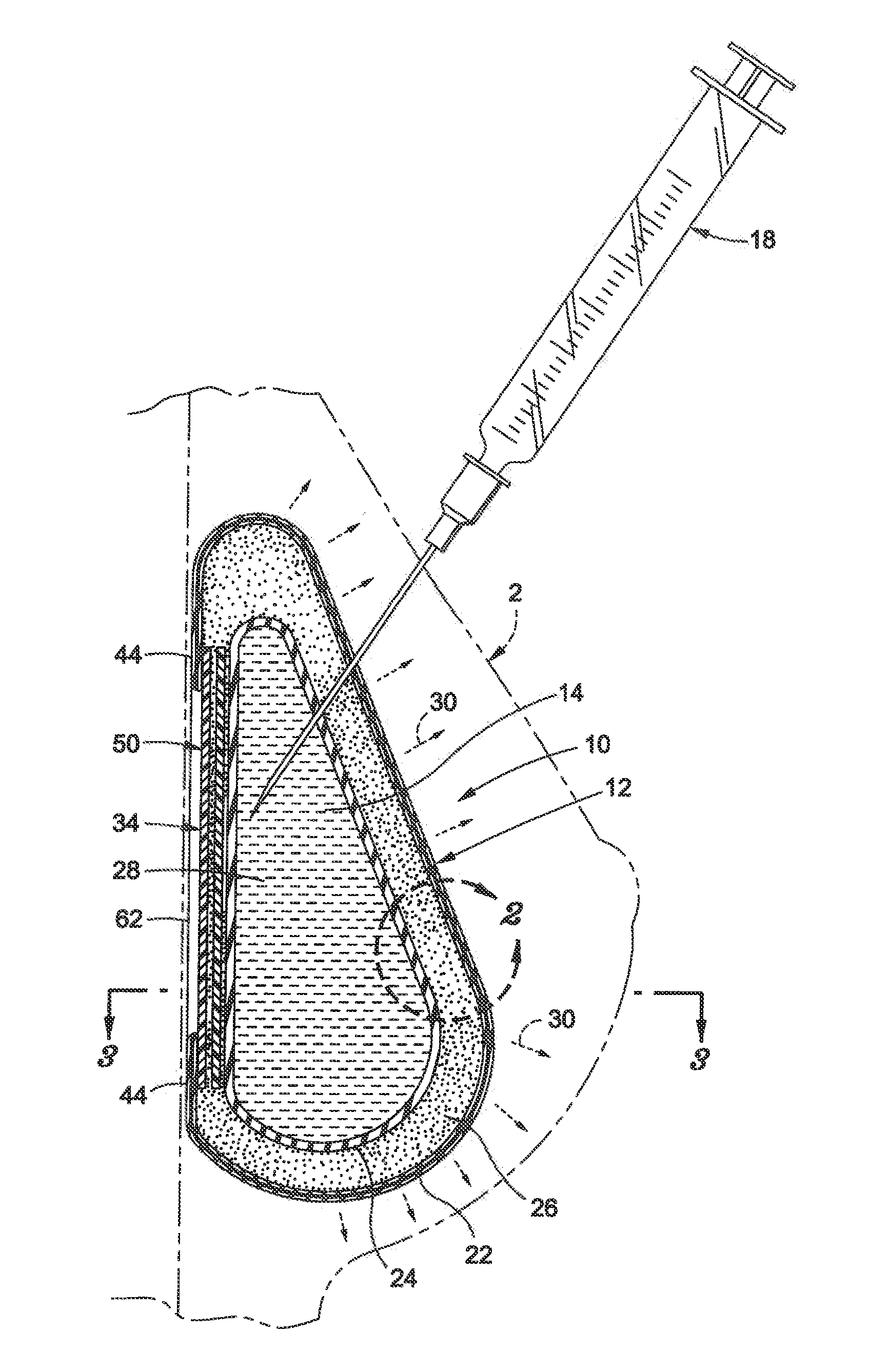 Inflatable prostheses and methods of making same