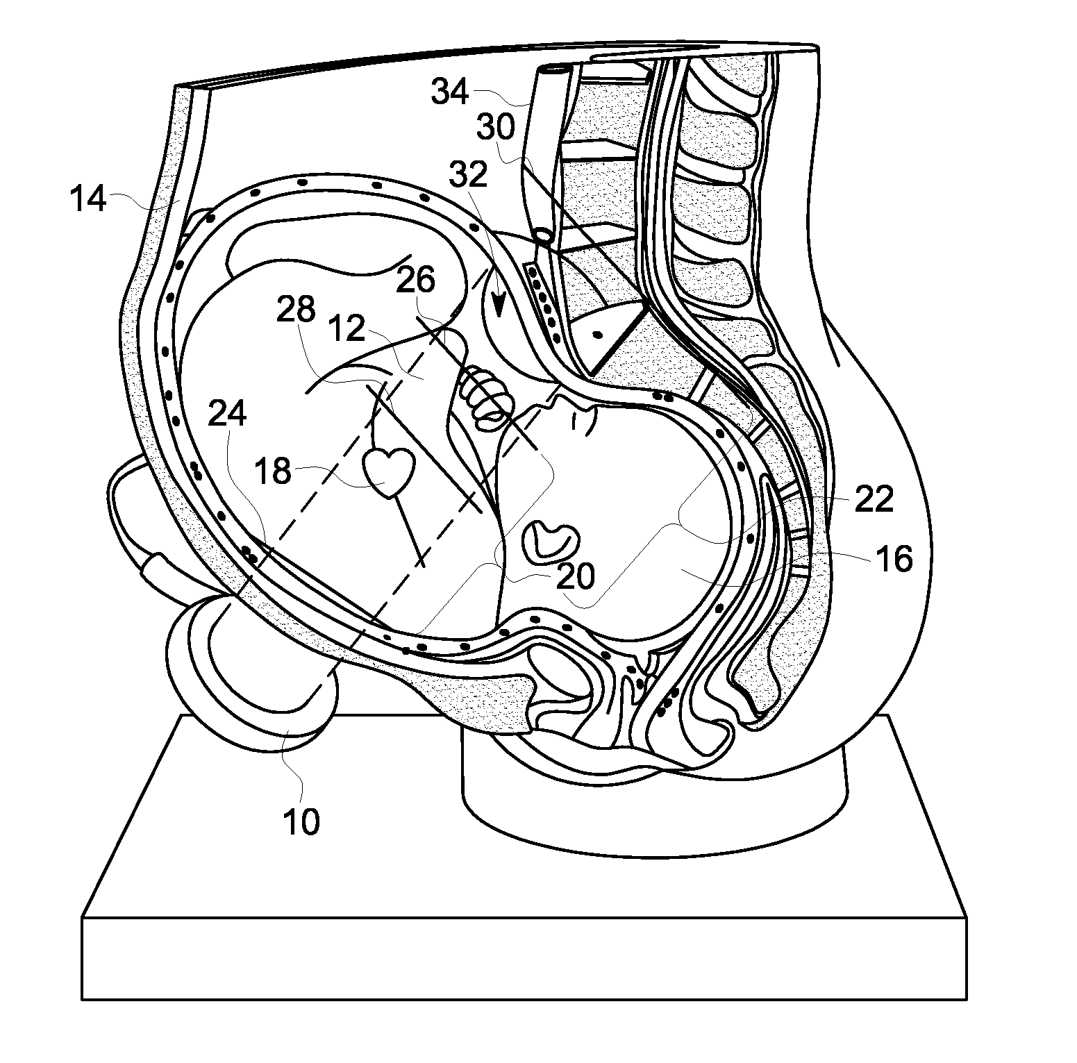 Method and Device for Fetal Heart Rate Monitoring with Maternal Contribution Detection
