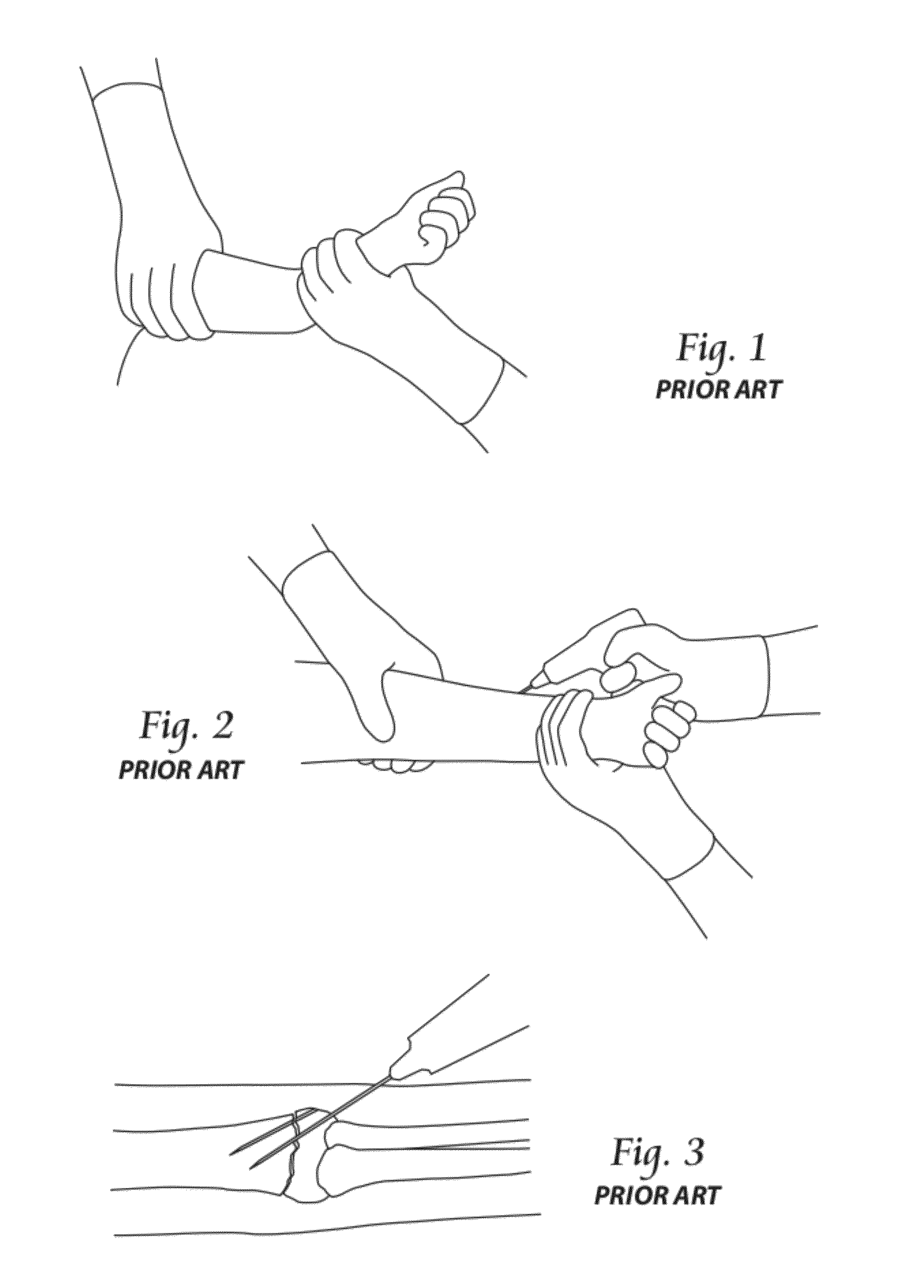 Systems, Devices, and Methods for Mechanically Reducing and Fixing Bone Fractures