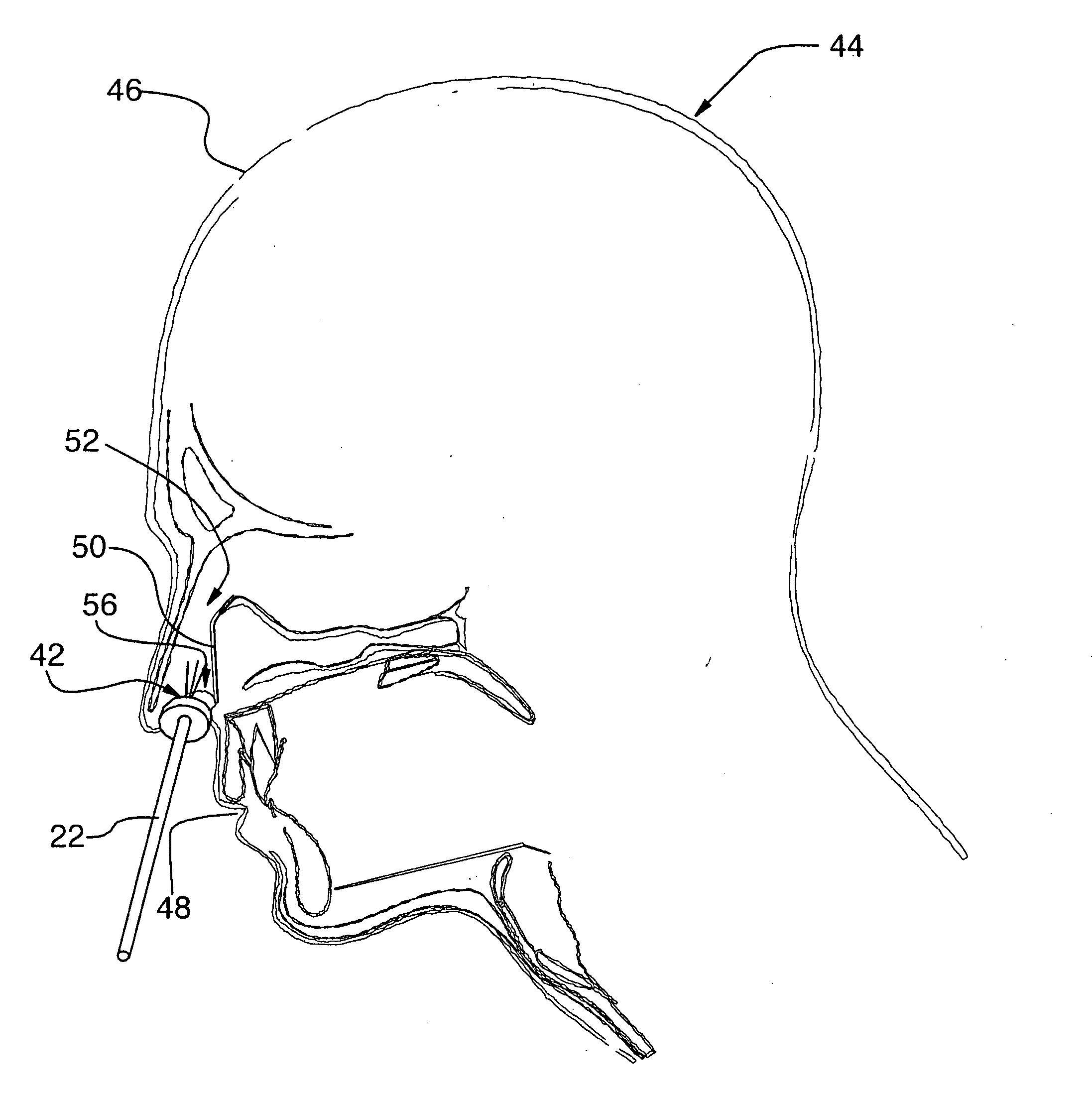 Method and apparatus for alleviating nasal congestion