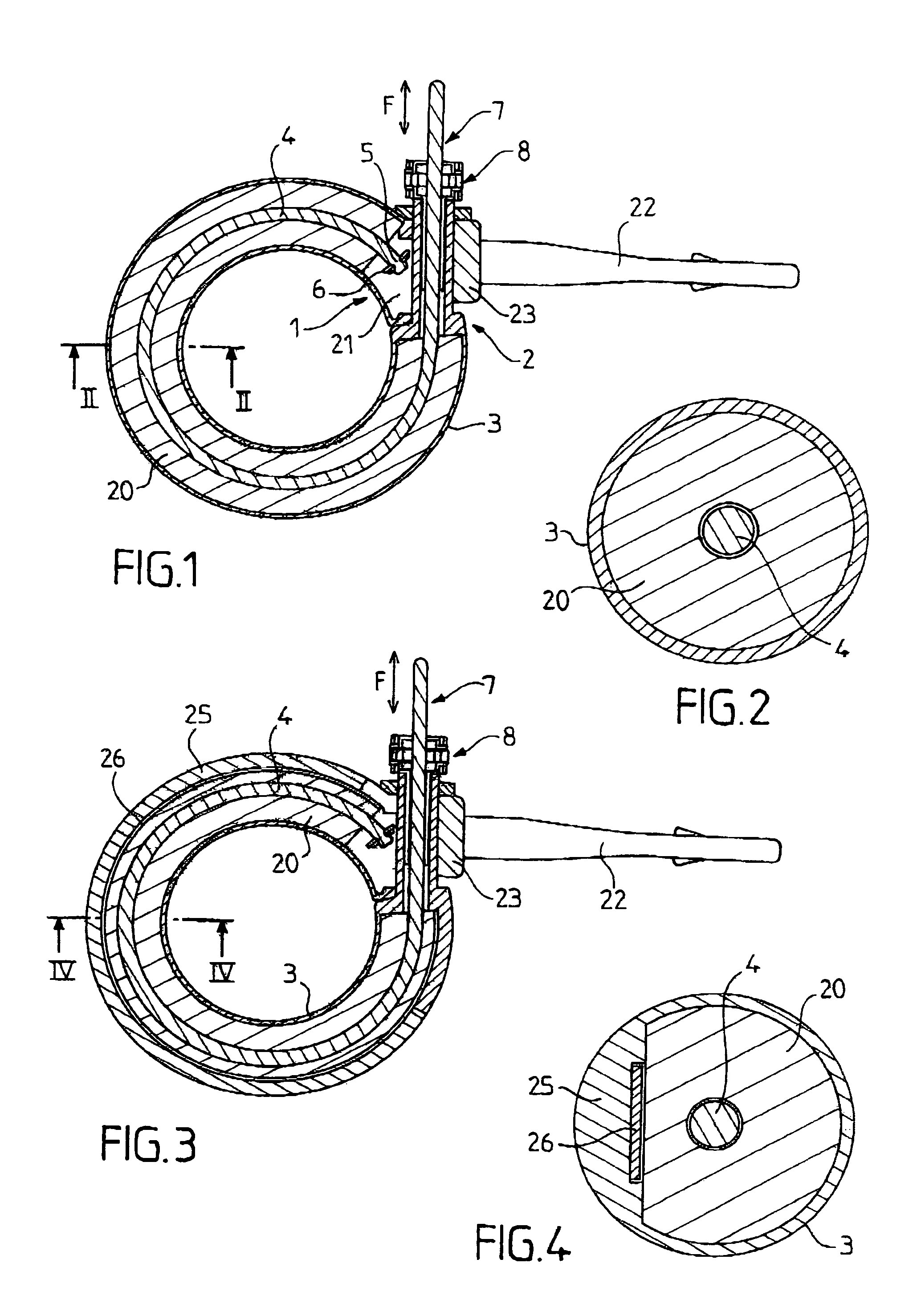 Surgical ring featuring a reversible diameter remote control system