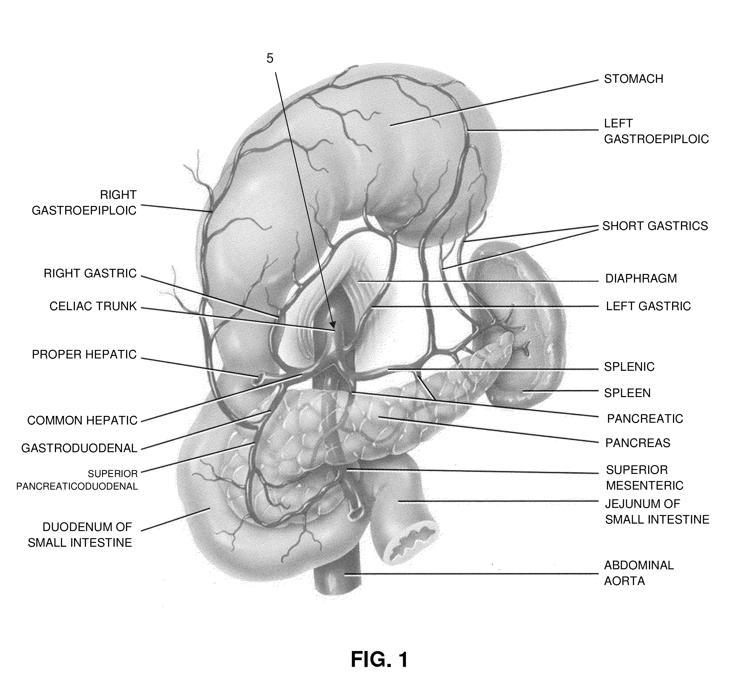 Method and apparatus for treating a patient by intentionally occluding a blood vessel, including method and apparatus for inducing weight loss in a patient by intentionally occluding the celiac artery