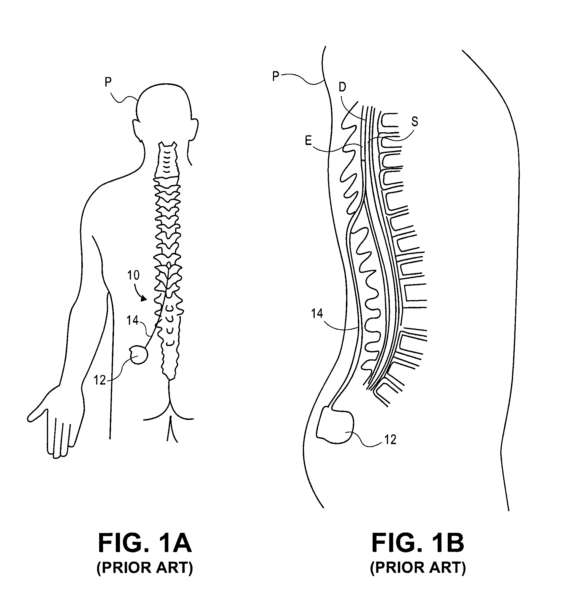 Grouped leads for spinal stimulation