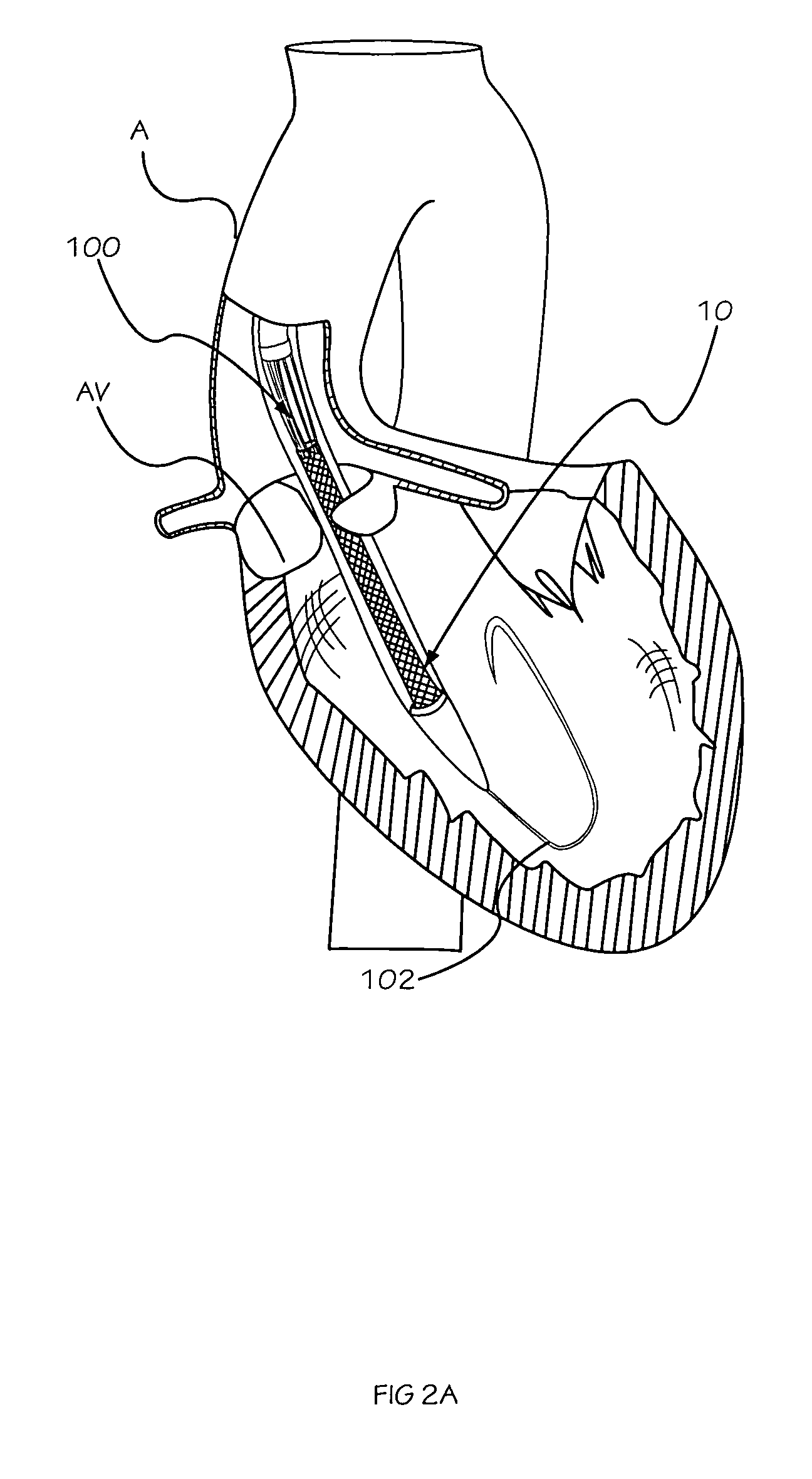 Methods and apparatus for performing valvuloplasty