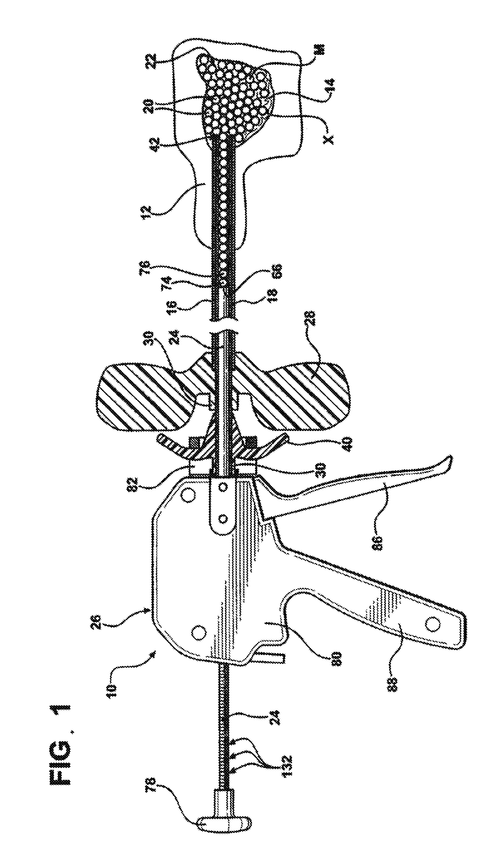 System and method for deliverying an agglomeration of solid beads and cement to the interior of a bone in order to form an implant within the bone