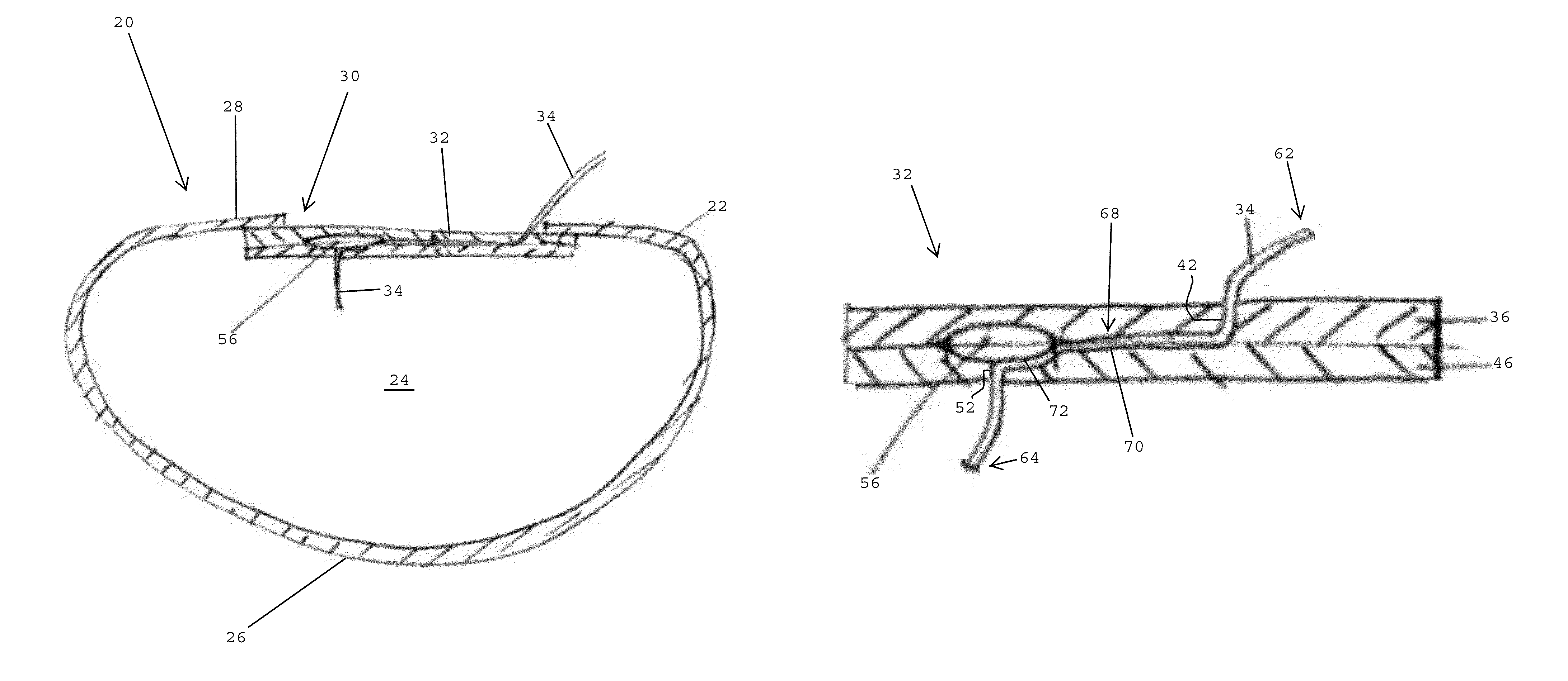 Valve assemblies for implantable prostheses and tissue expanders