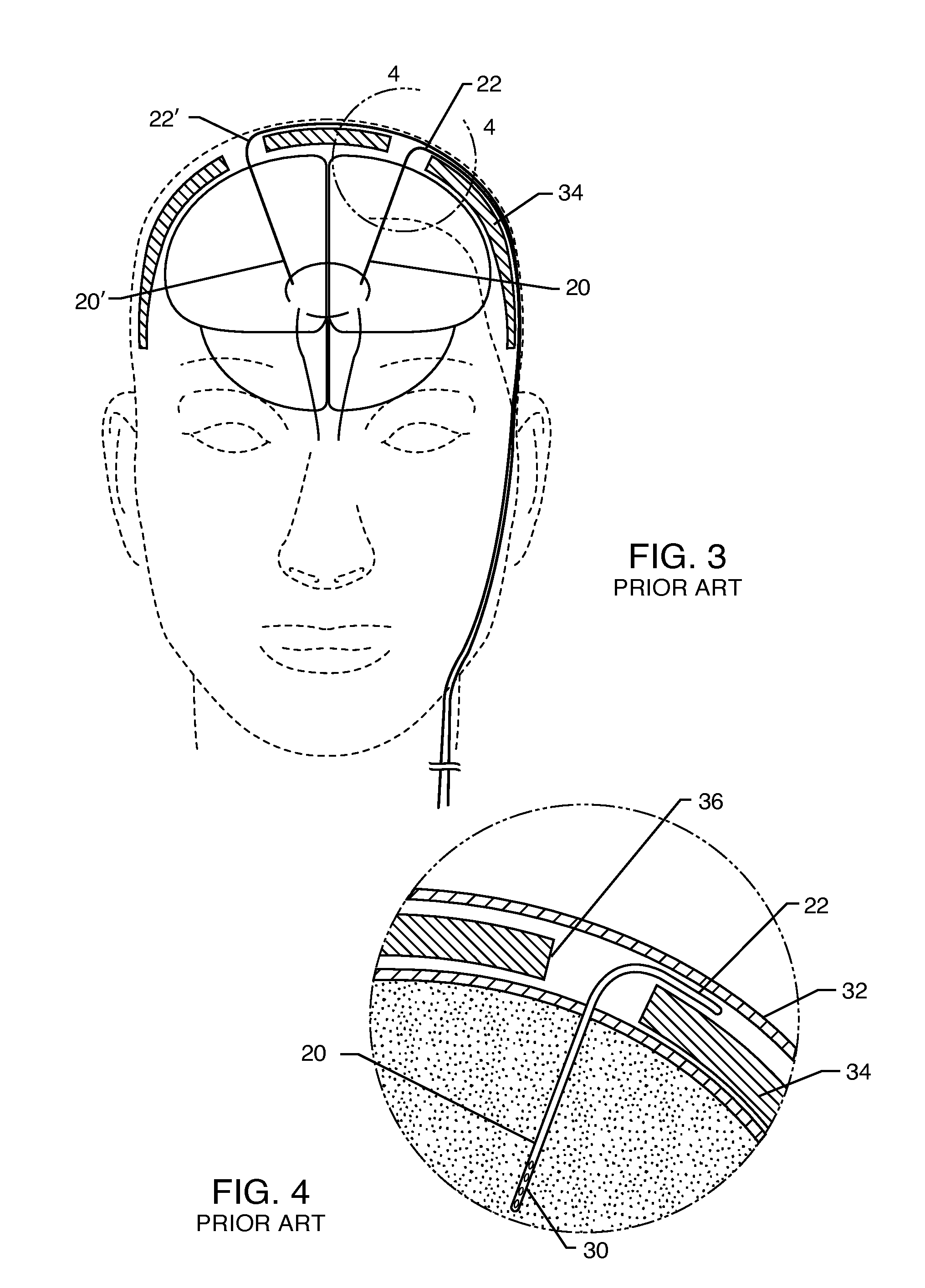 Satellite therapy delivery system for brain neuromodulation