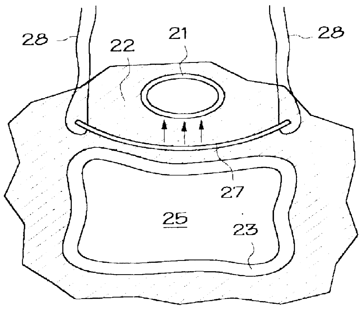 Intraurethral pressure monitoring assembly and method of treating incontinence using same