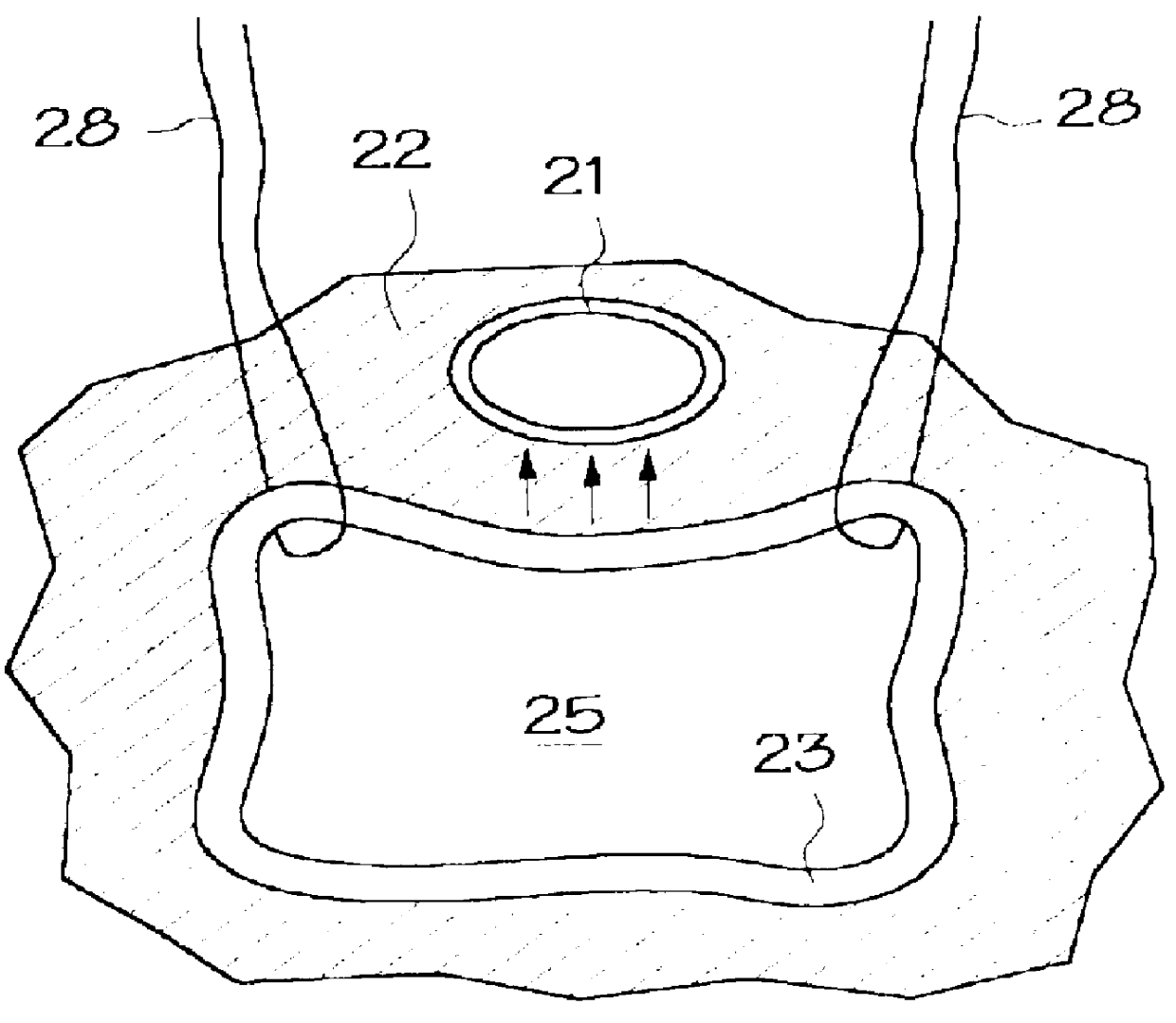 Intraurethral pressure monitoring assembly and method of treating incontinence using same