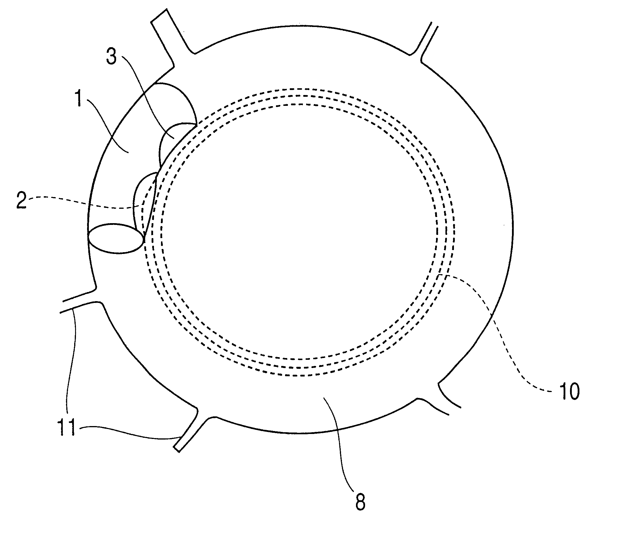 Device for improving in a targeted manner and/or permanently ensuring the ability of the aqueous humor to pass through the trabecular meshwork