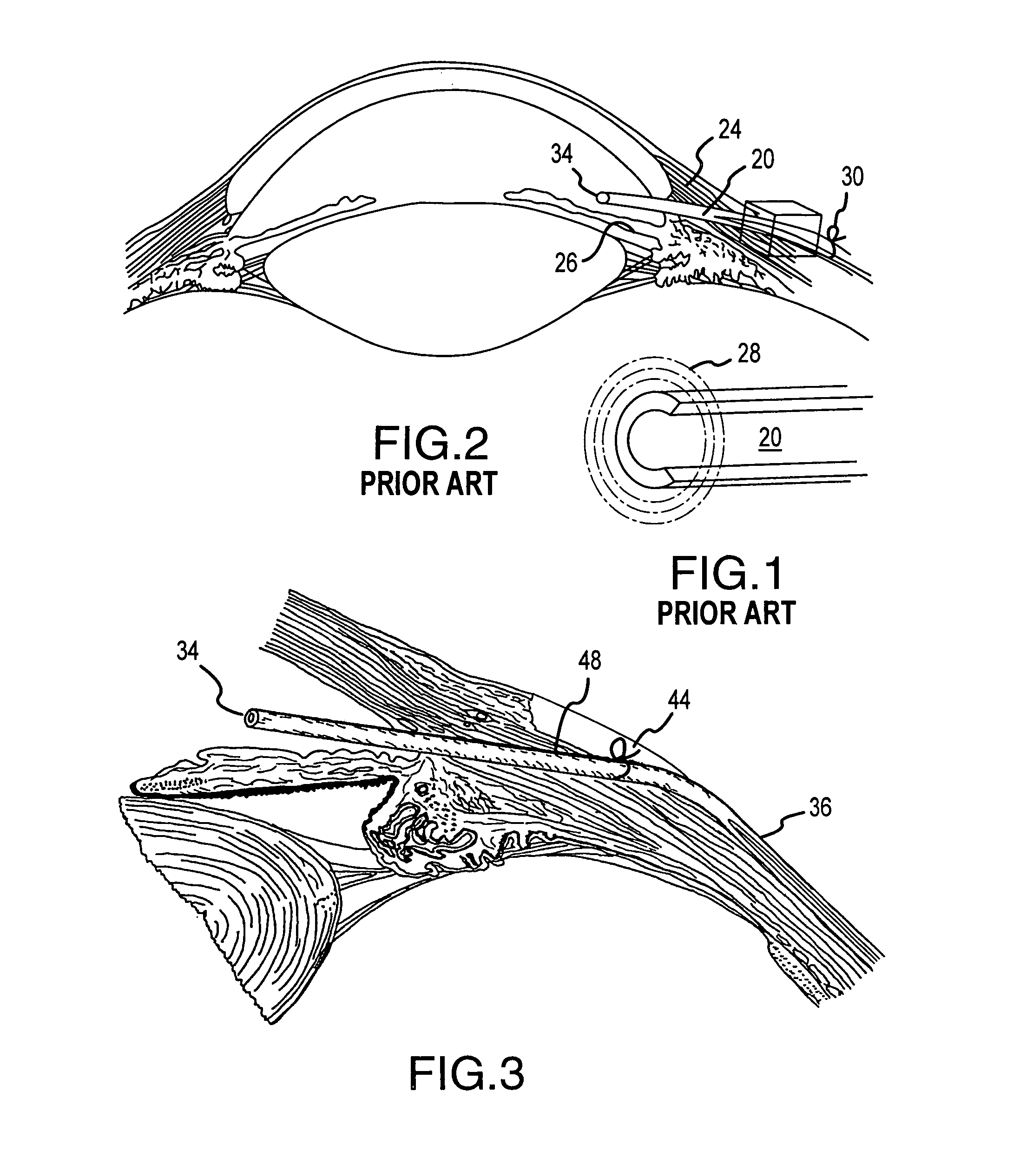 C-shaped cross section tubular ophthalmic implant for reduction of intraocular pressure in glaucomatous eyes and method of use