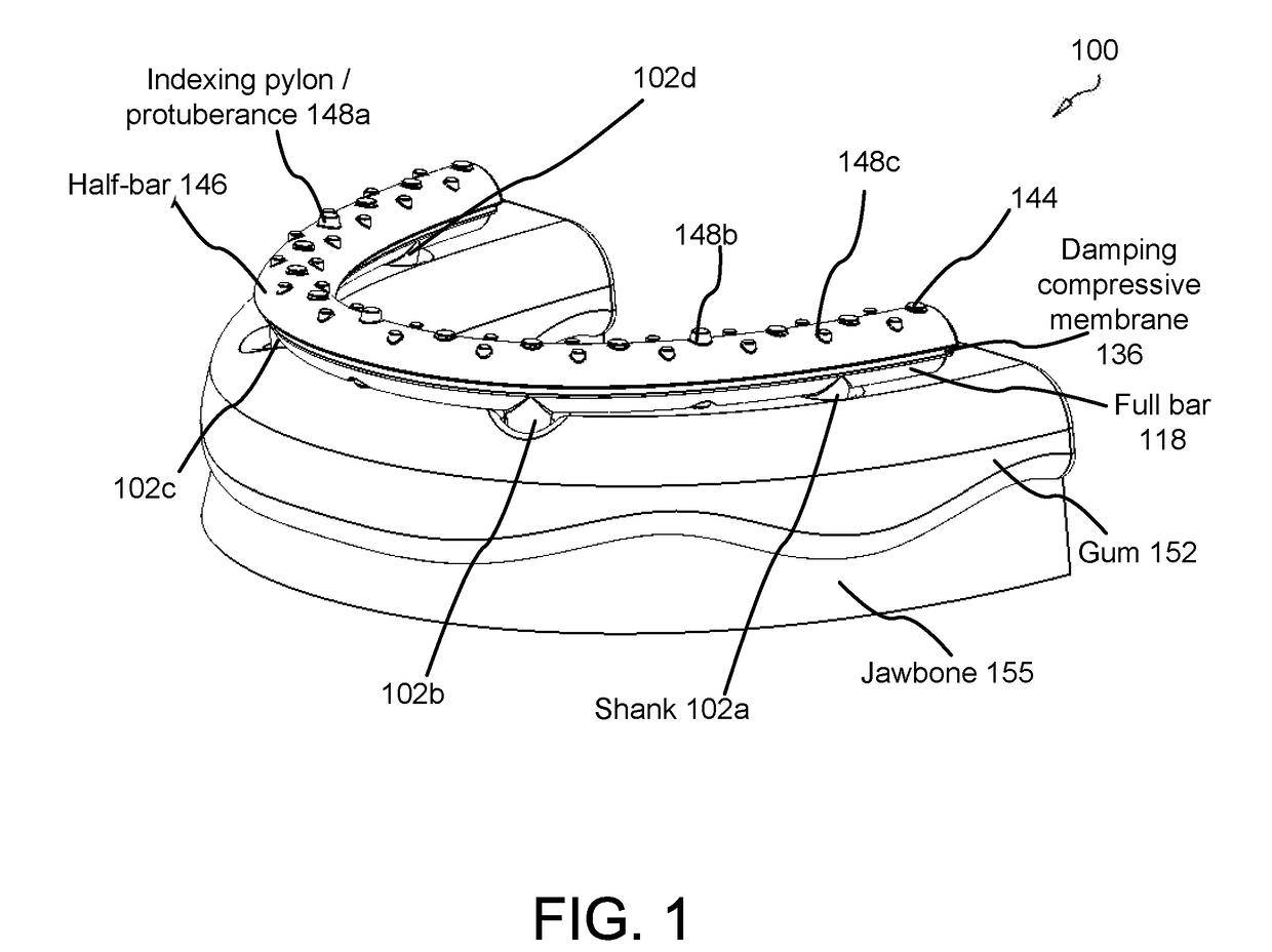Force damping dental bridge assembly with synthetic periodontal ligament fibers