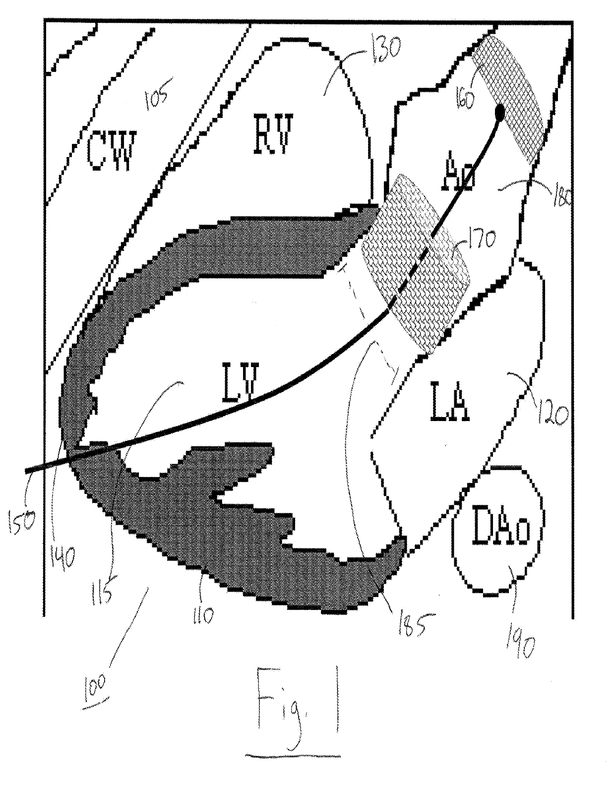 Devices and methods for image-guided percutaneous cardiac valve implantation and repair