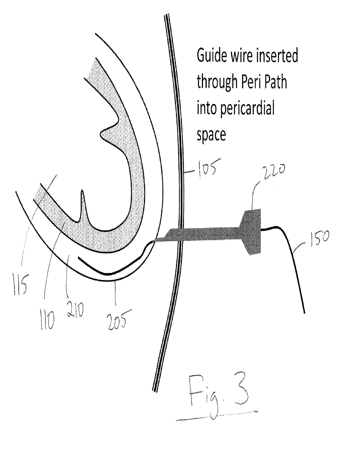 Devices and methods for image-guided percutaneous cardiac valve implantation and repair