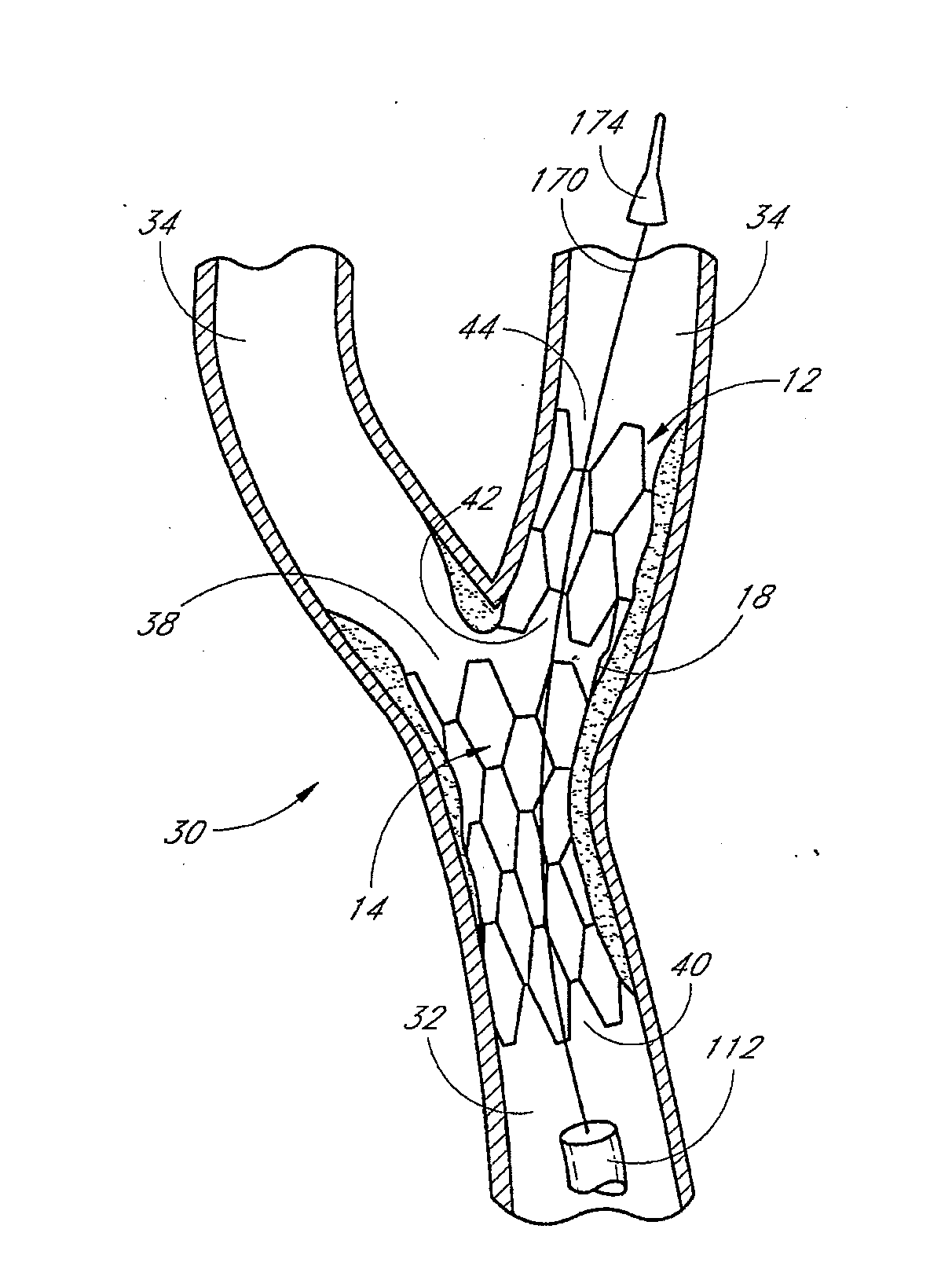 Bifurcation stent and method of positioning in a body lumen