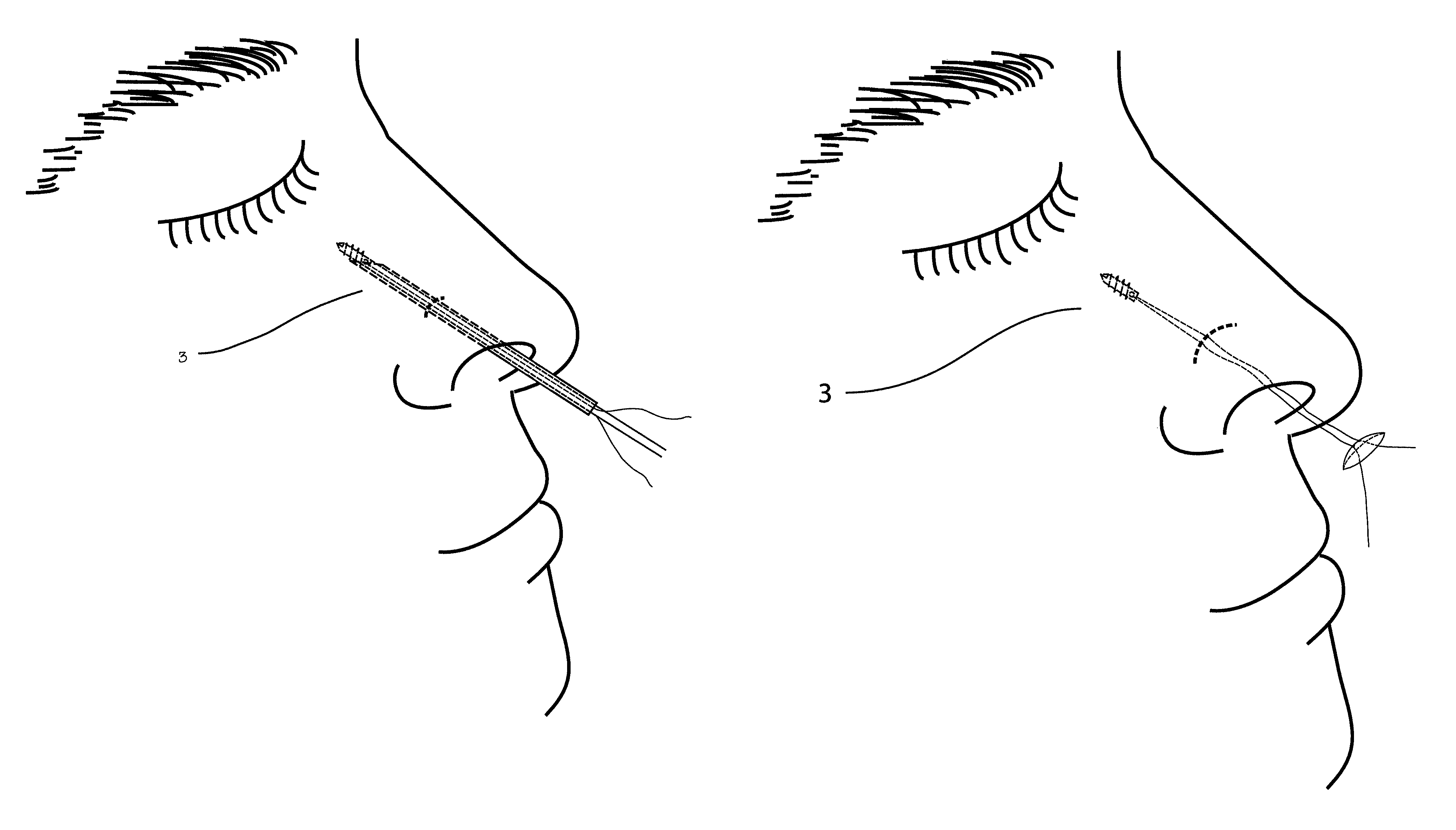 Device and method for nasal surgery