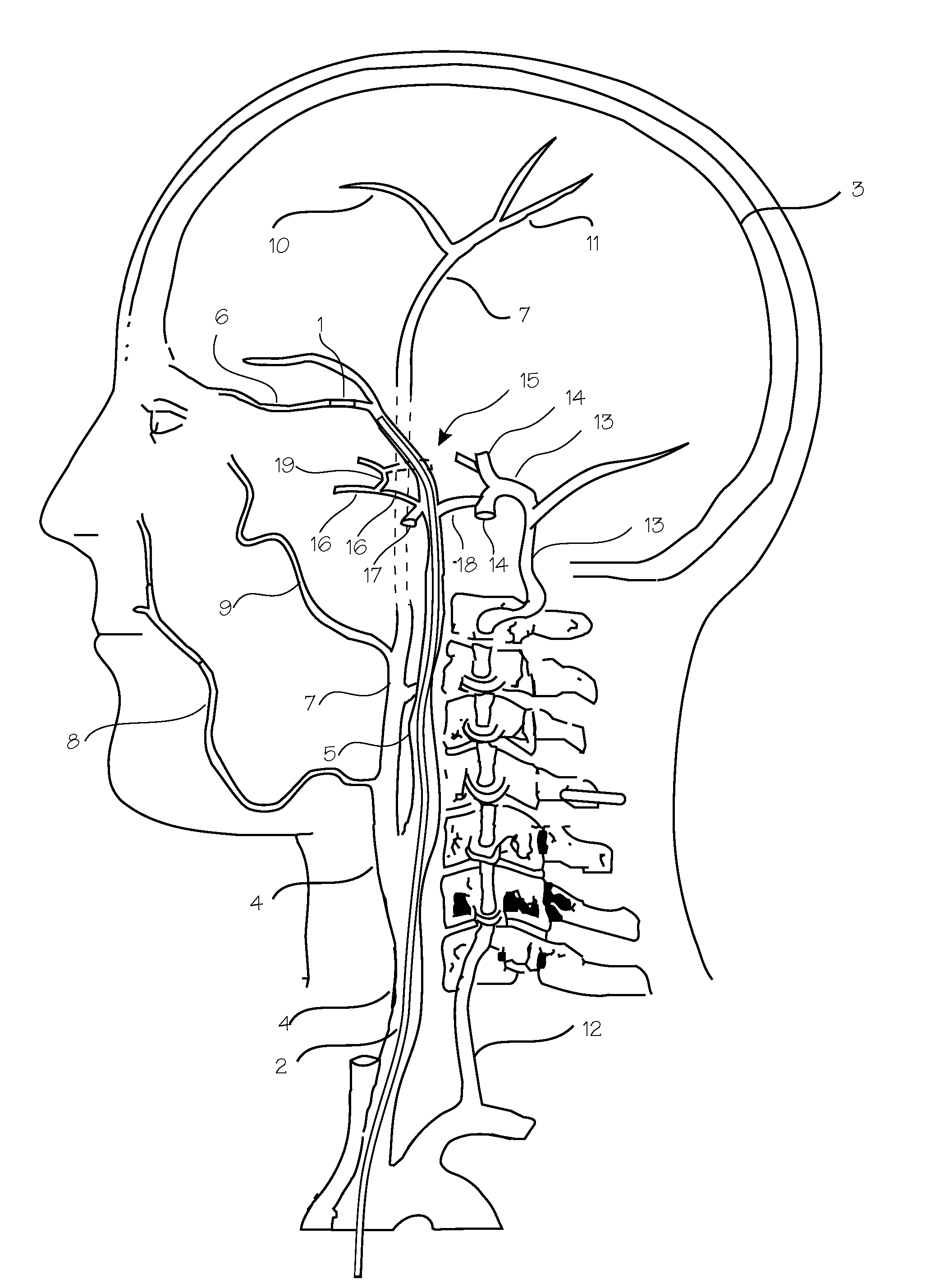 Intracranial Stent and Method of Use