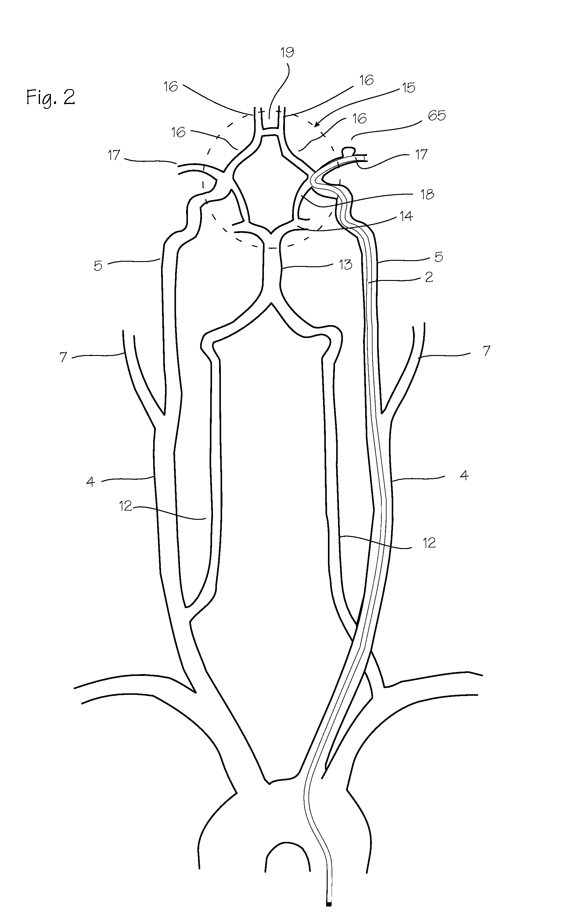 Intracranial Stent and Method of Use