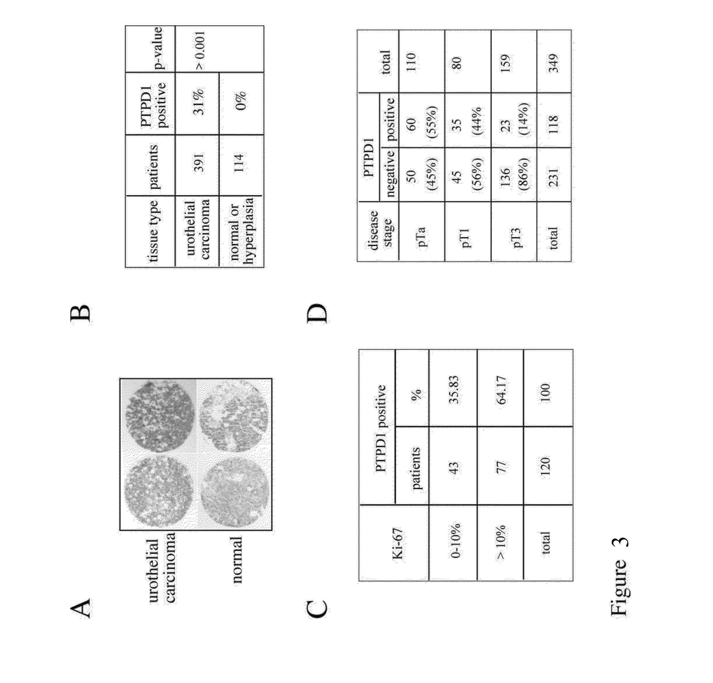 Method for Diagnosis of Bladder Cancer and Related Kits