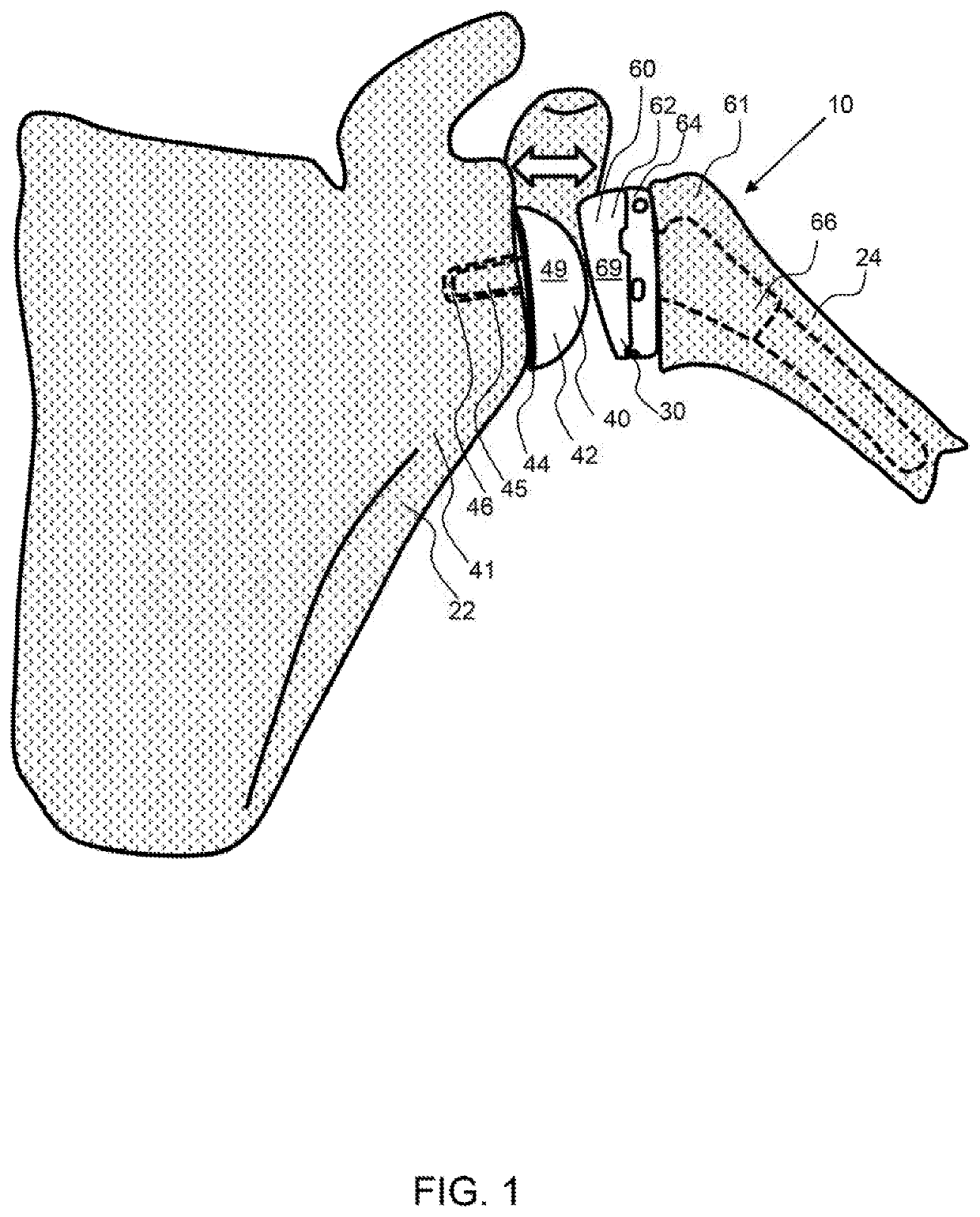 Joint Replacement And In Situ Gauge System