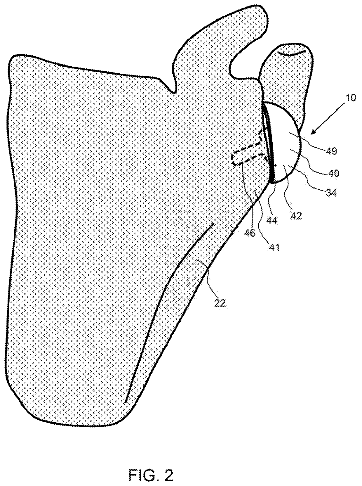 Joint Replacement And In Situ Gauge System