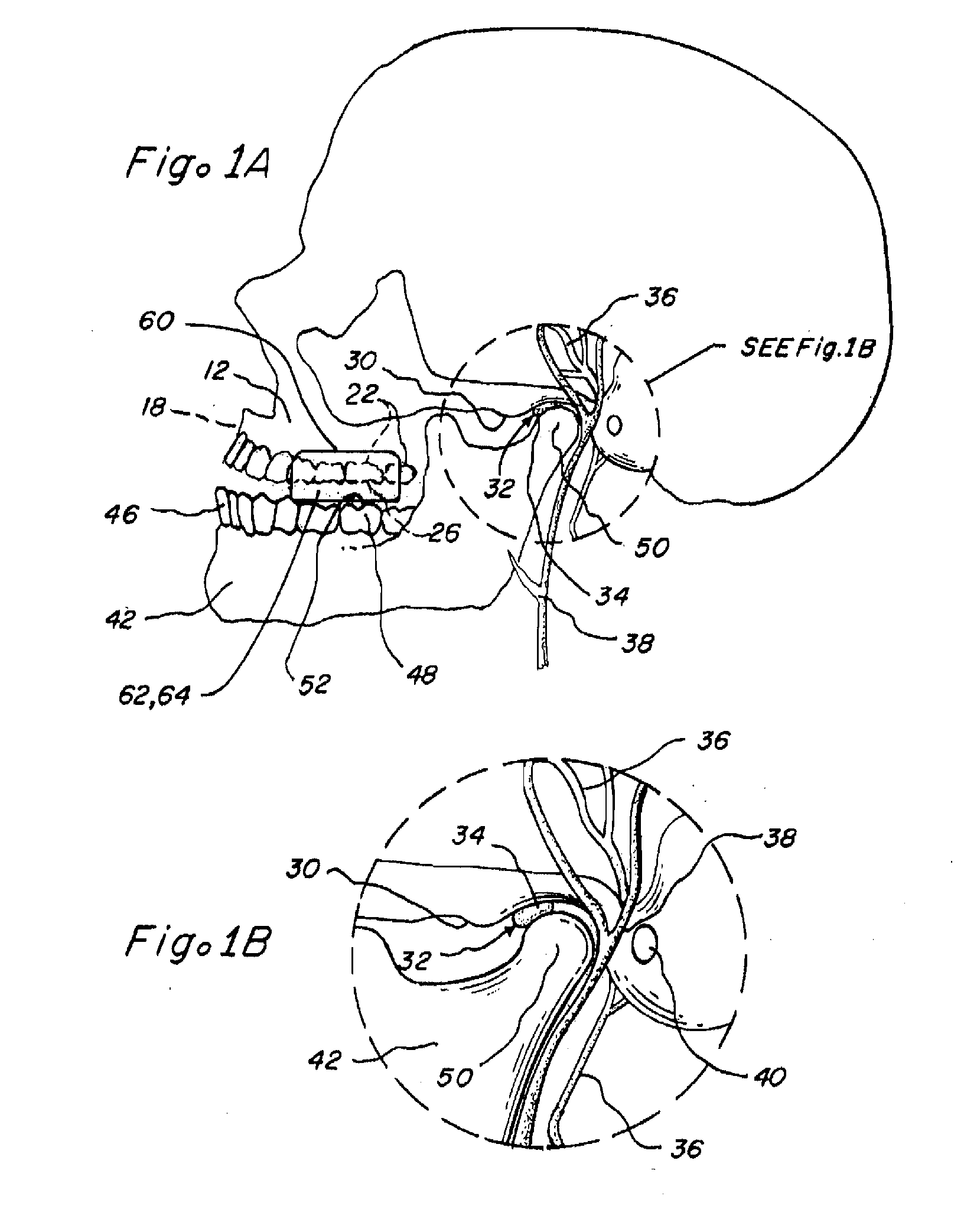 Methods and apparatus for reduction of lactate